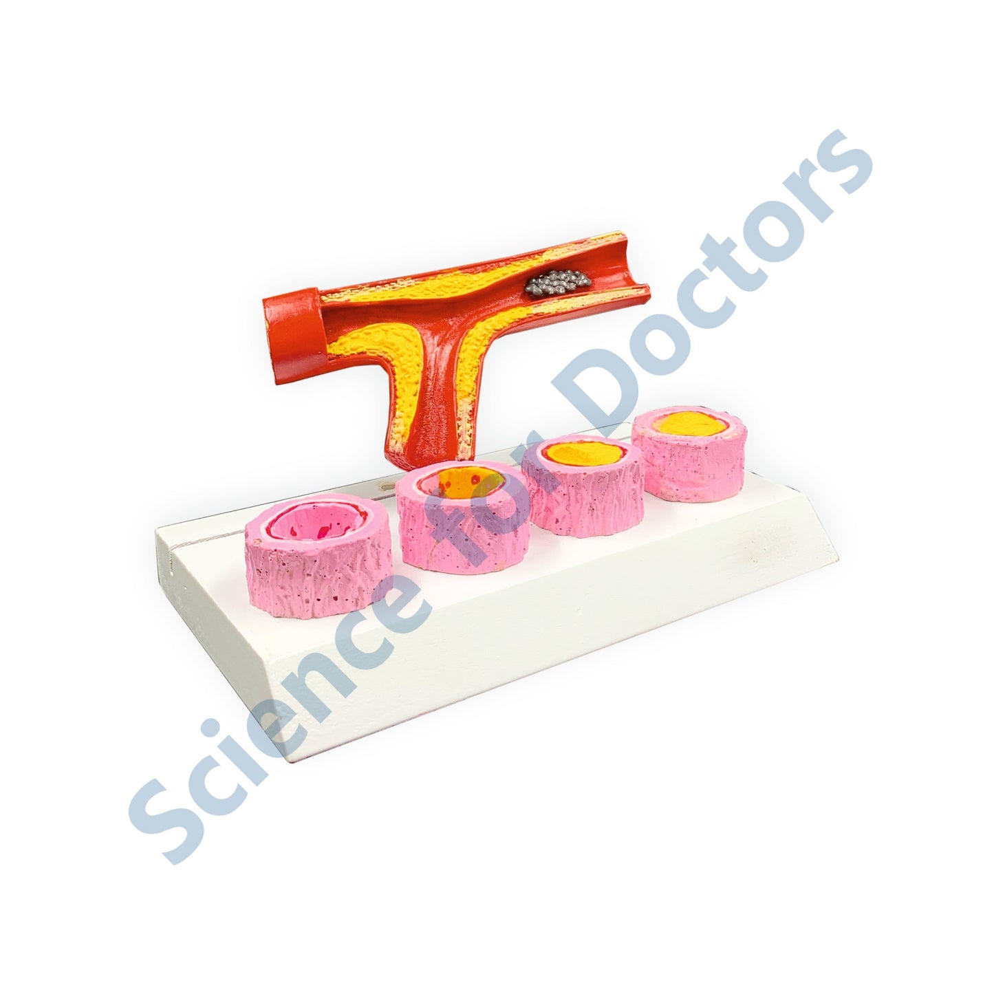 Atherosclerosis: 3D Anatomical Models