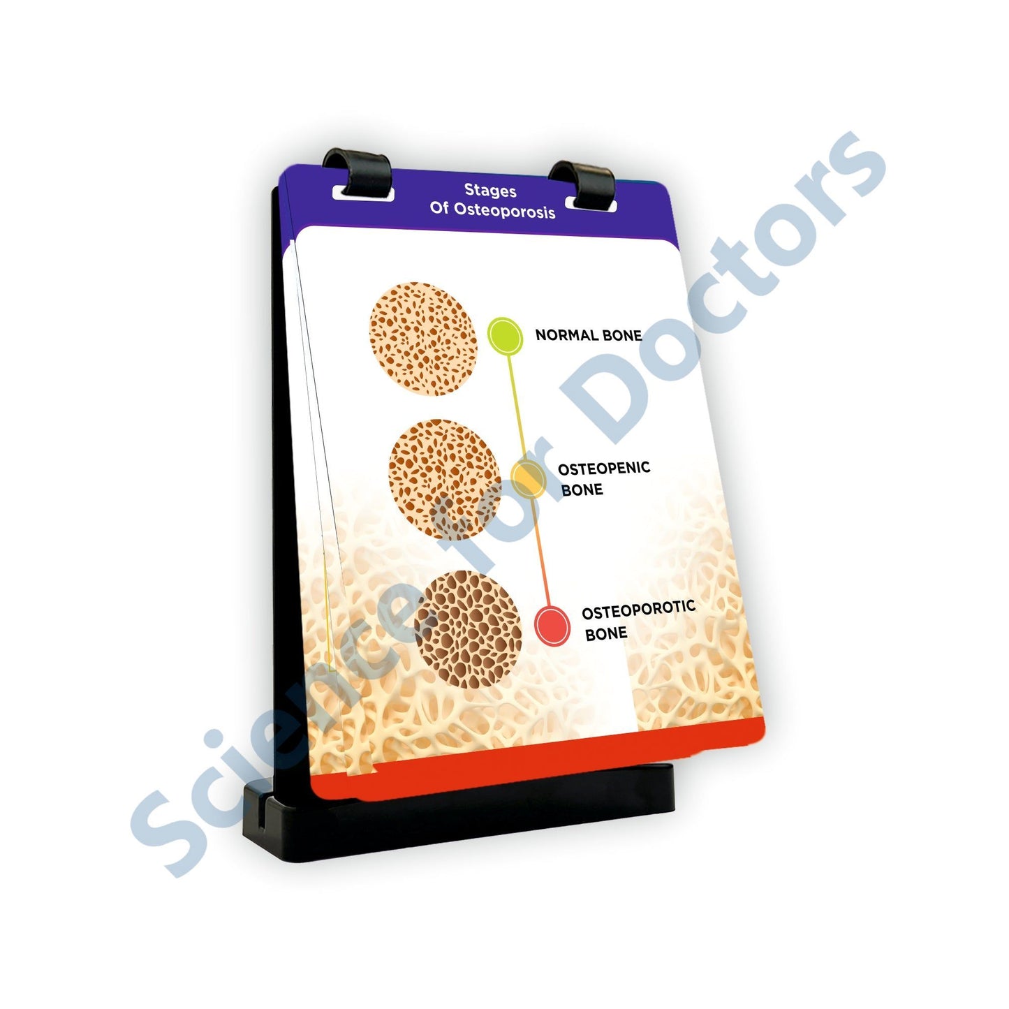 Stages of Osteoporosis: A4 Flip Wipe