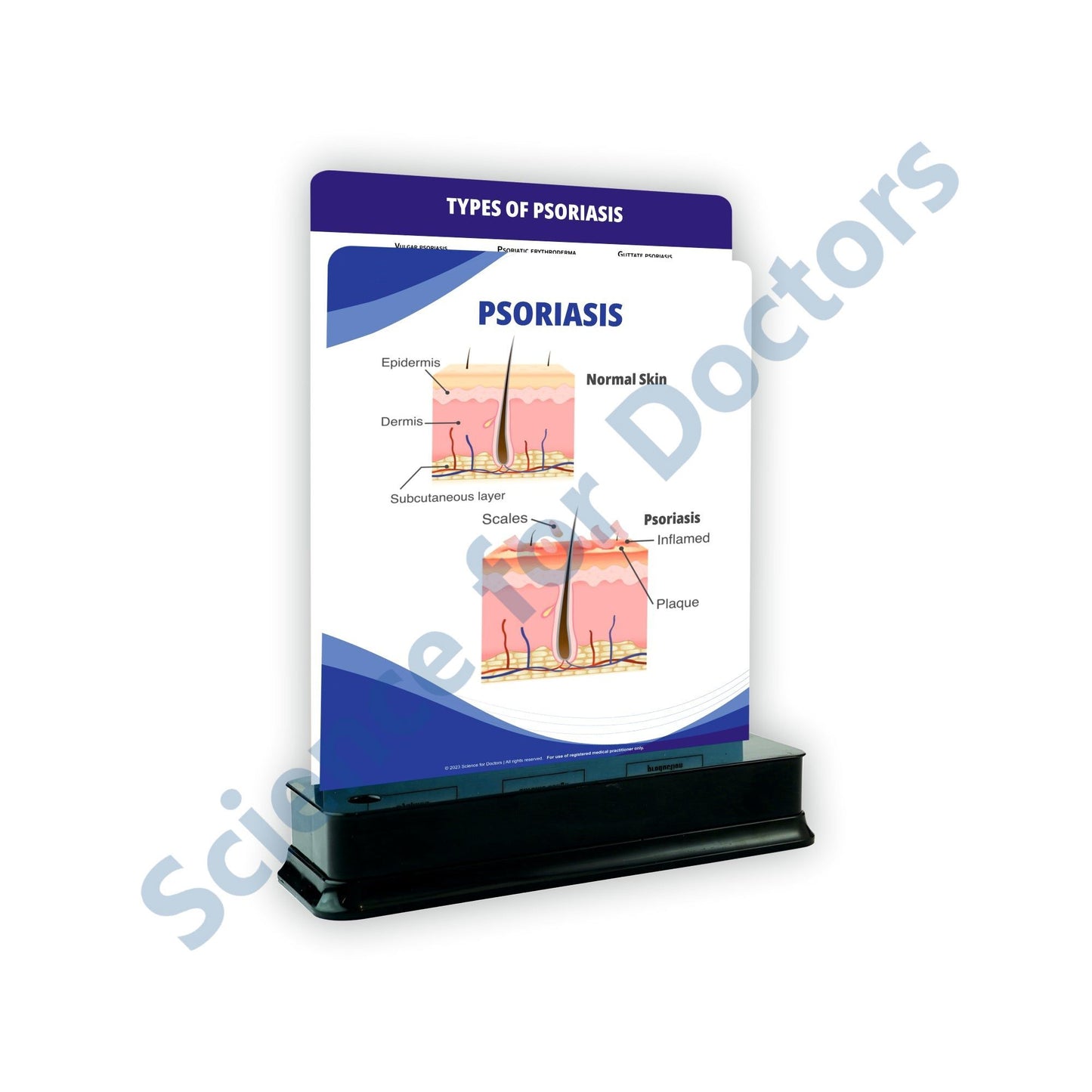 Psoriasis: 2 Slide on stand