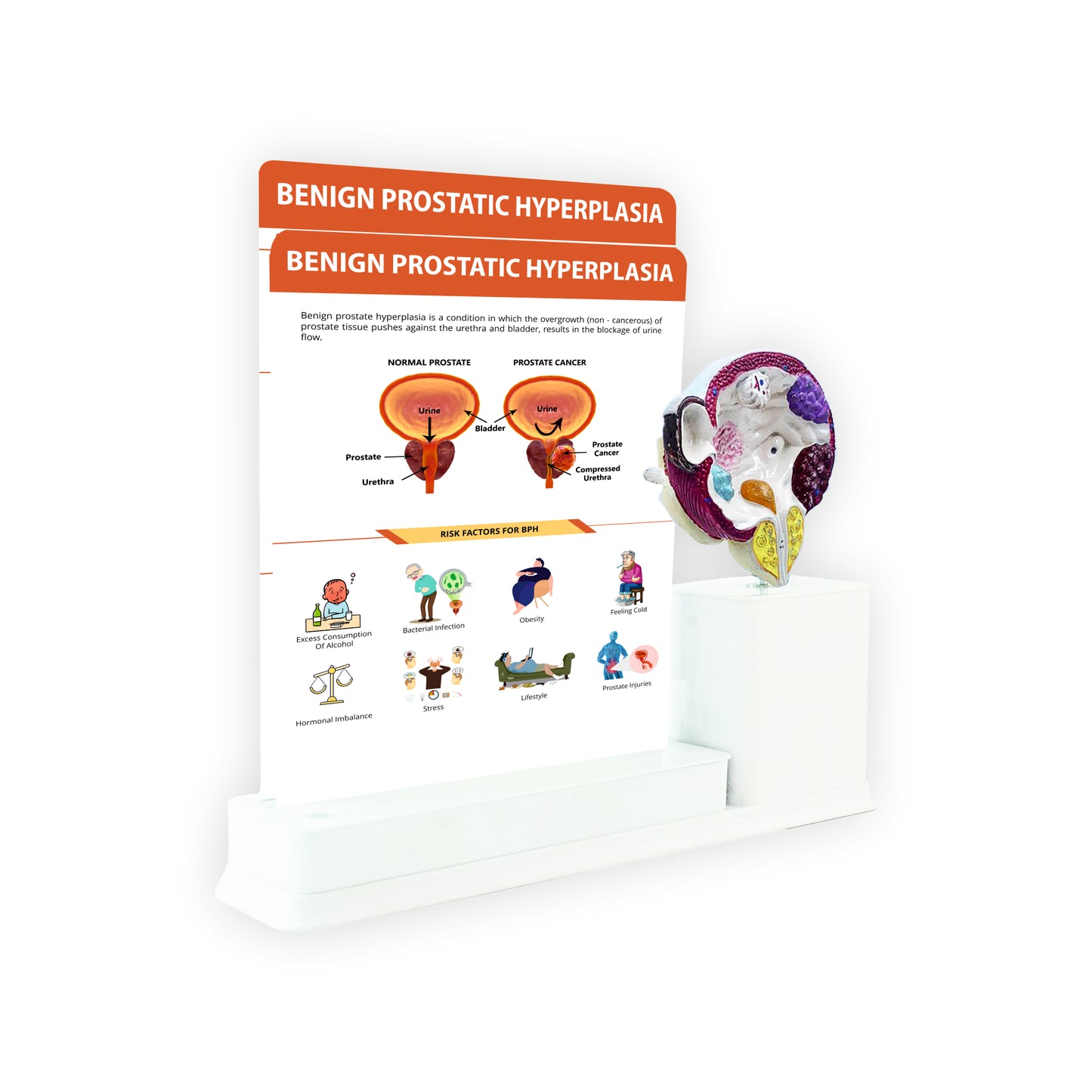 Benign Prostatic Hyperplasia : 2 Slides Write and Wipe with Model On Stand