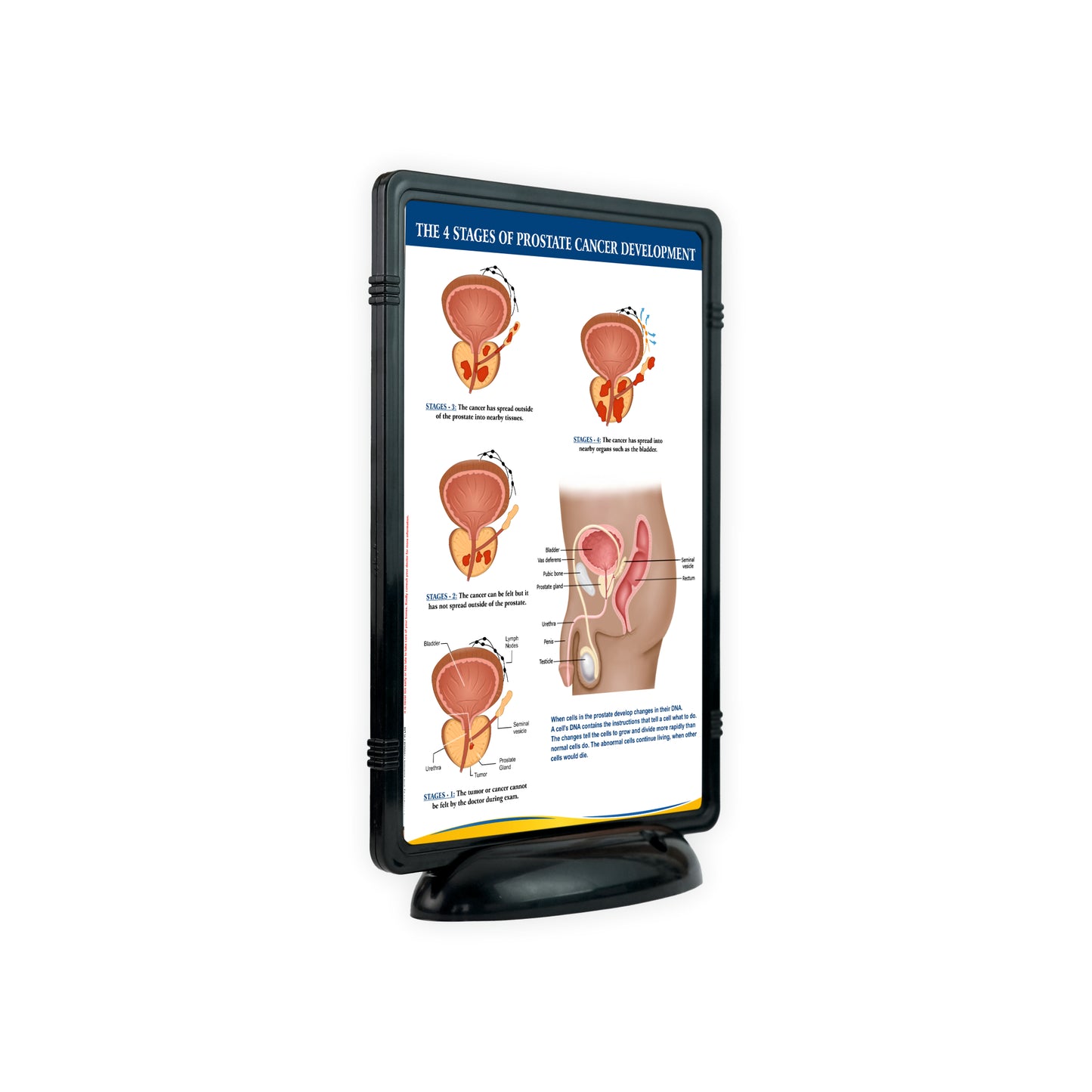 The 4 Stages of Prostate Cancer Development: The Frame Write & Wipe