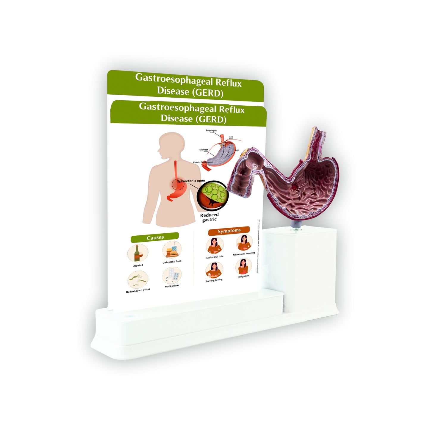 Gastroesophageal Reflux Disease: 2 Slides Write and Wipe with Model On Stand