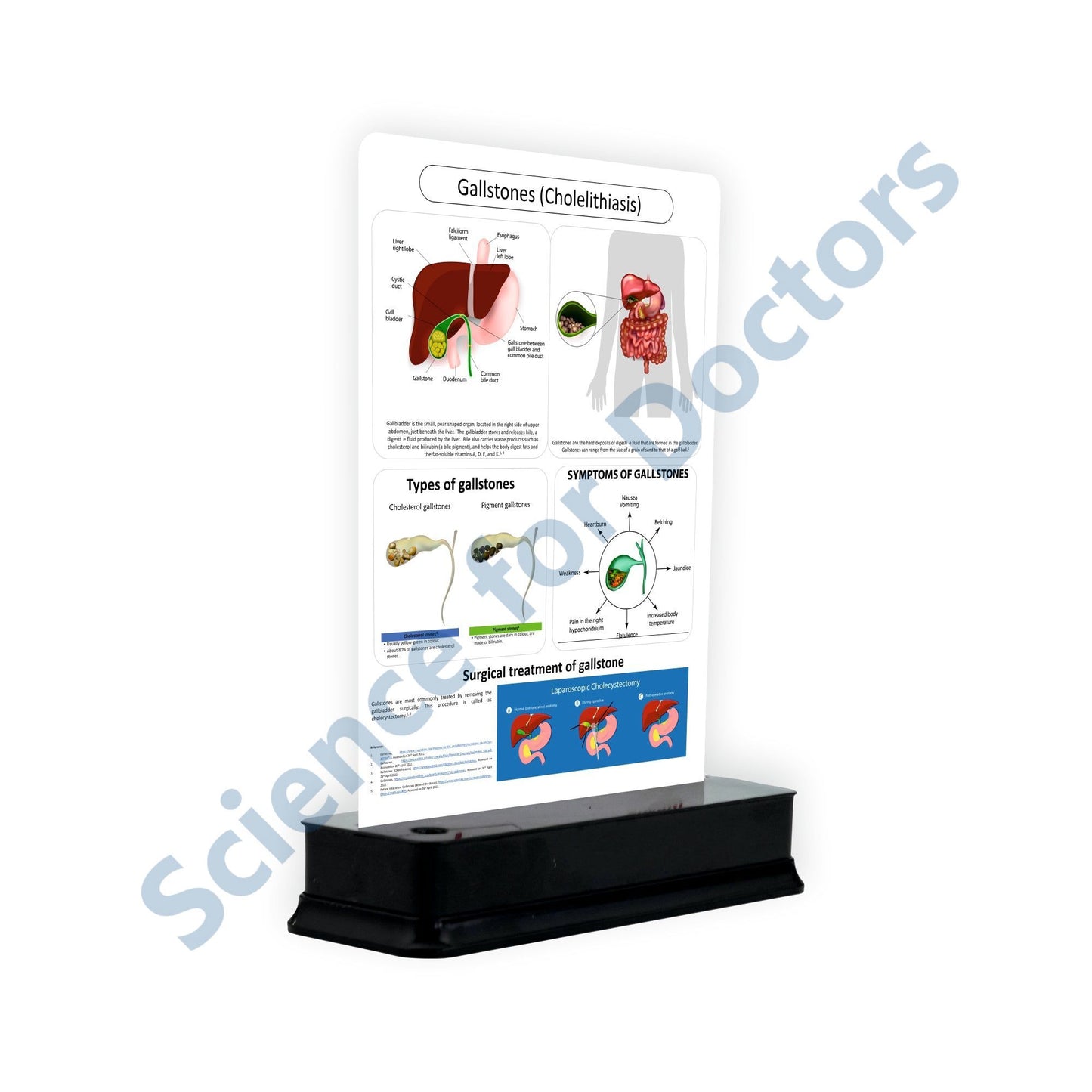 Gallstones (Cholelithiasis): 1 Slide with Stand