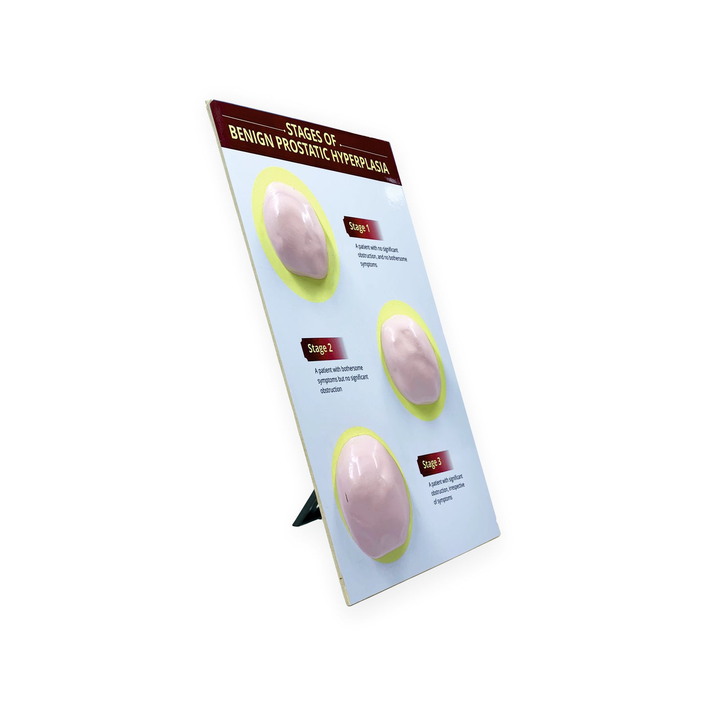 Stages of Benign Prostatic Hyperplasia: 3D Therapy Board