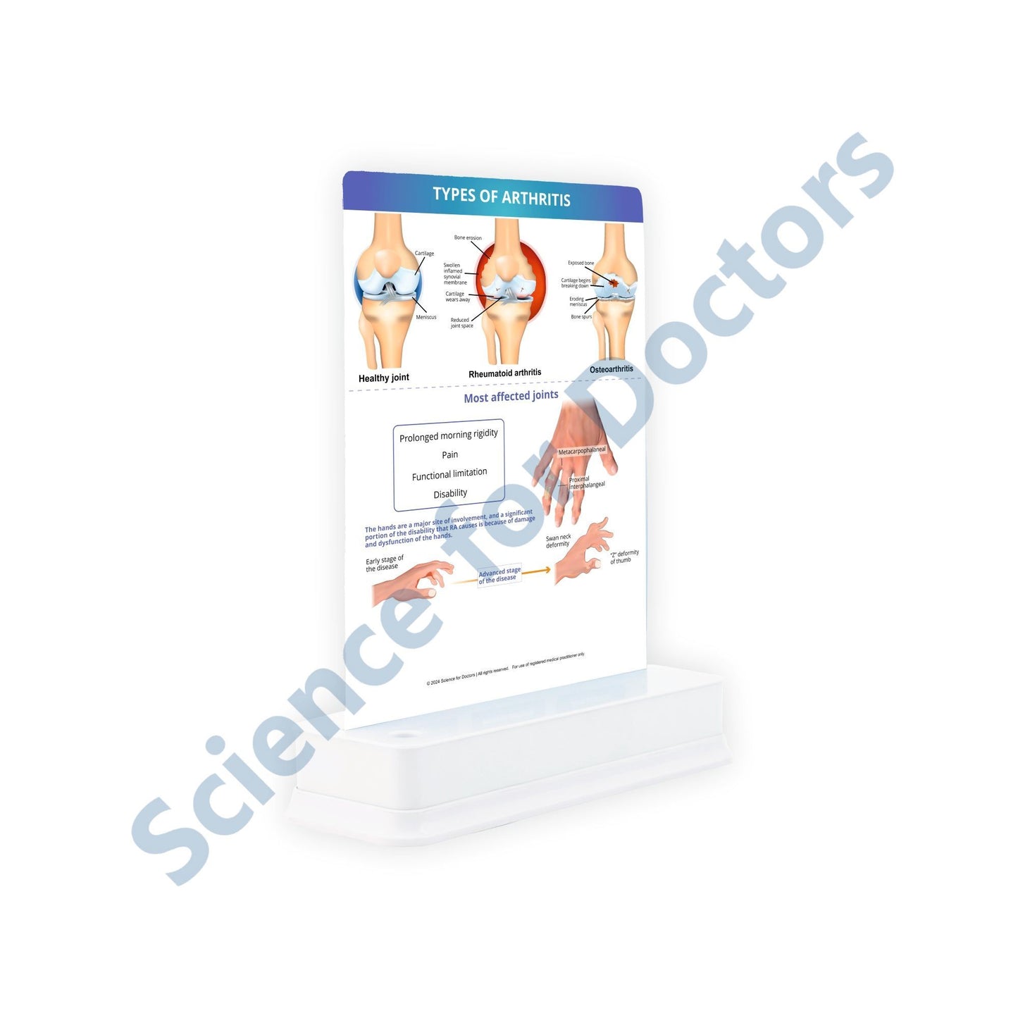 Types of Arthritis: 1 Slide on stand