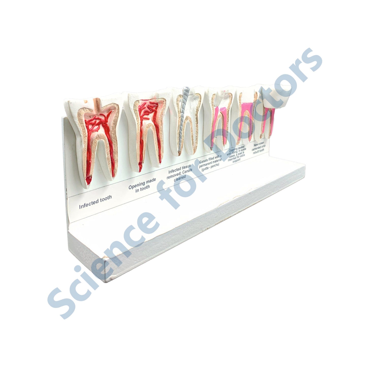 Stages of Root Canal: 3D Anatomical Models