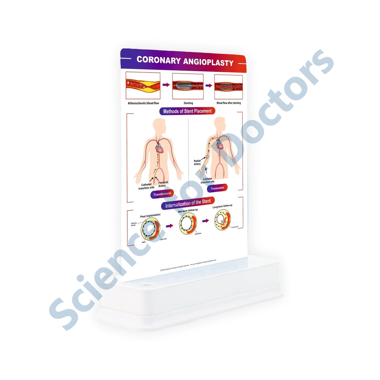 Coronary Angioplasty: 1 Slide With Stand