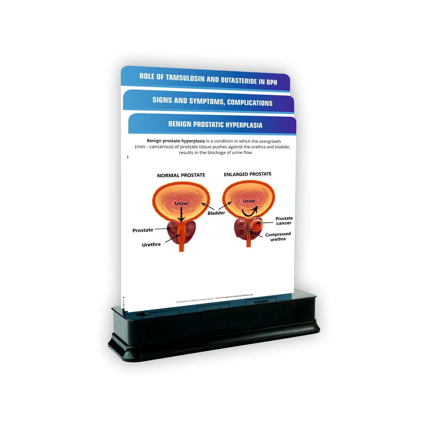 Benign Prostatic Hyperplasia_1 : 3 Slides on Stand