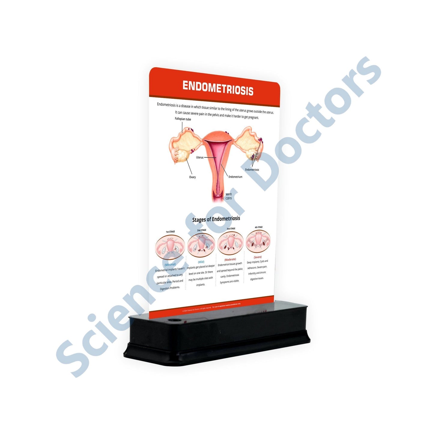 Endometriosis: 1 Slide on stand