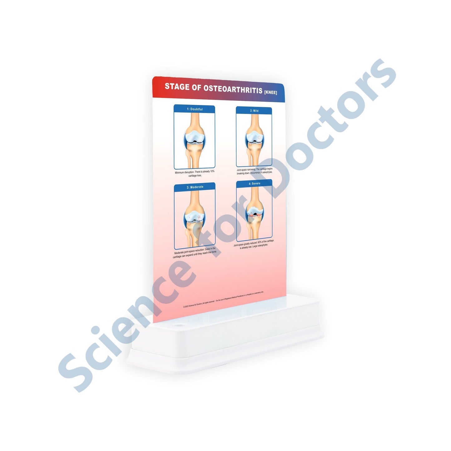 STAGE OF OSTEOARTHRITIS: 1 Slide on stand