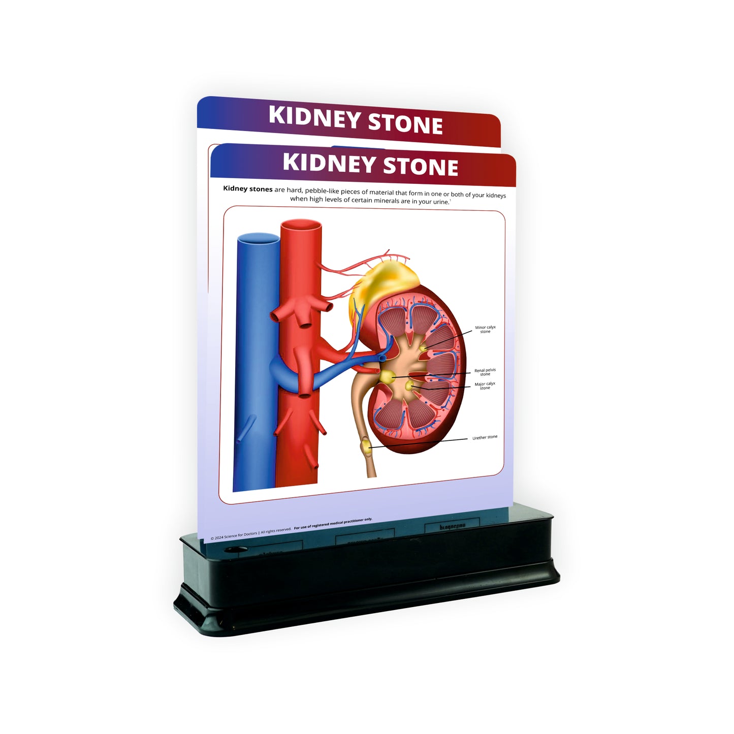 Kidney Stone : 2 Slides With Stand