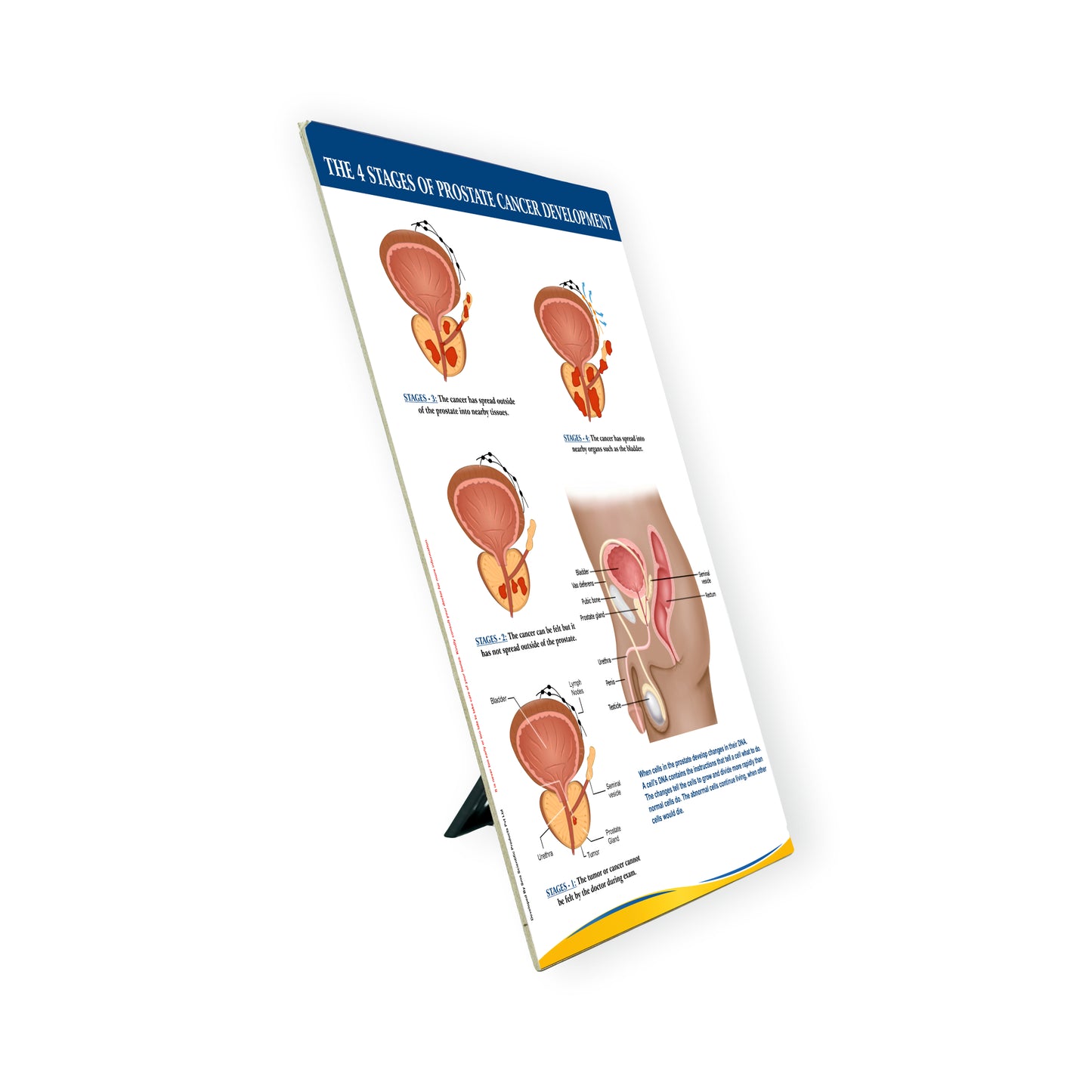 The 4 Stages of Prostate Cancer Development: Therapy Board