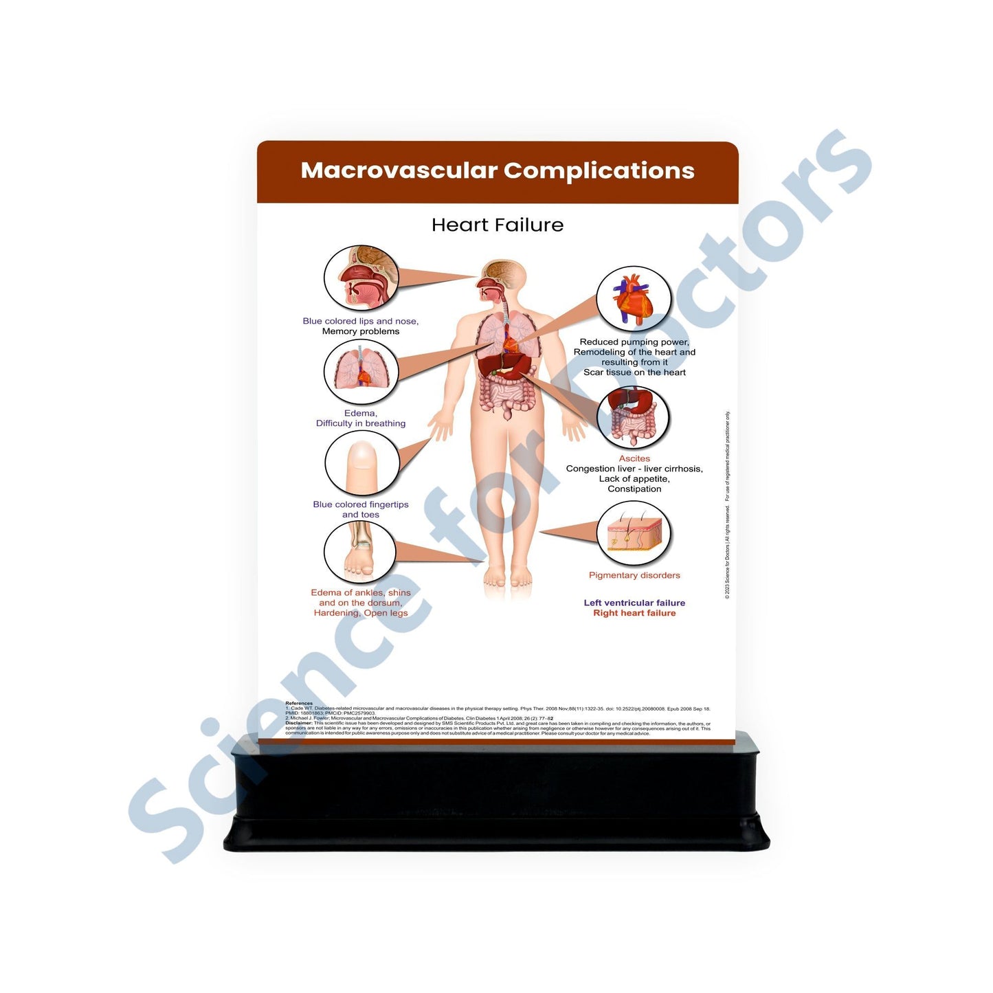Microvascular Complications: 2 Slides on stand