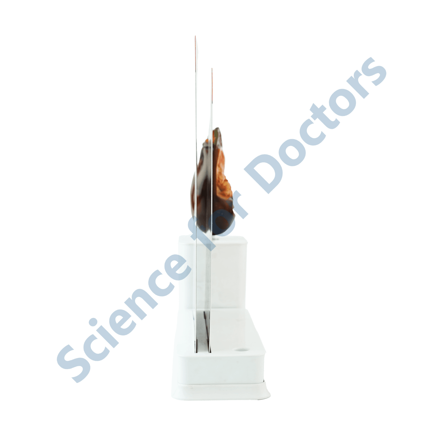 Microvascular Complications : 2 slide Write and Wipe with Anatomical Model