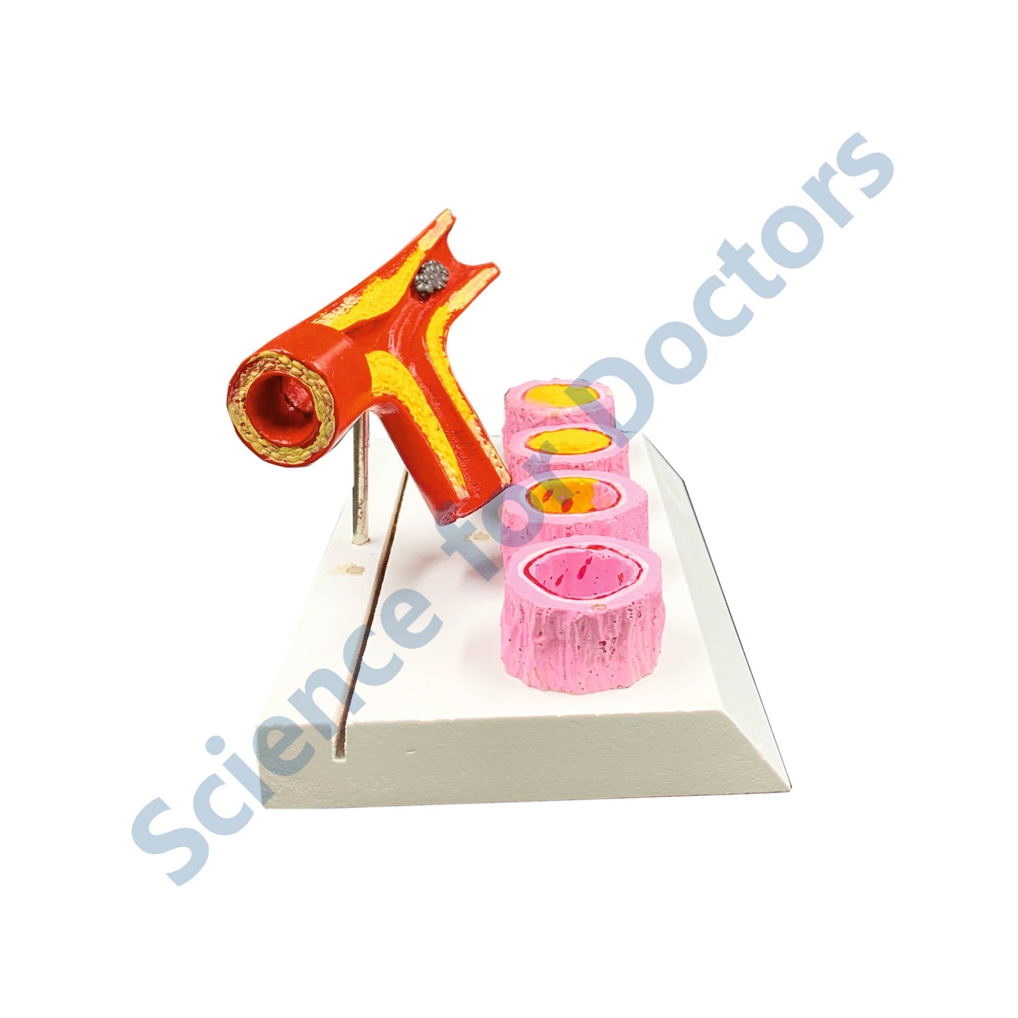 Atherosclerosis: 3D Anatomical Models