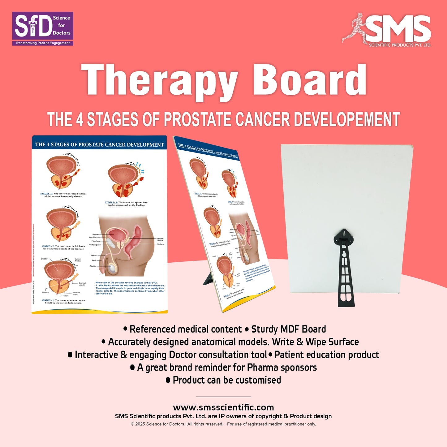 The 4 Stages of Prostate Cancer Development: Therapy Board