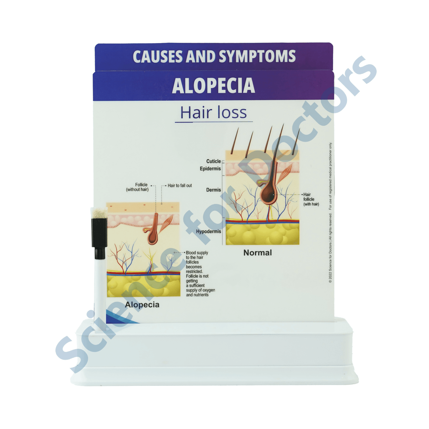 Alopecia: 2 slide on stand