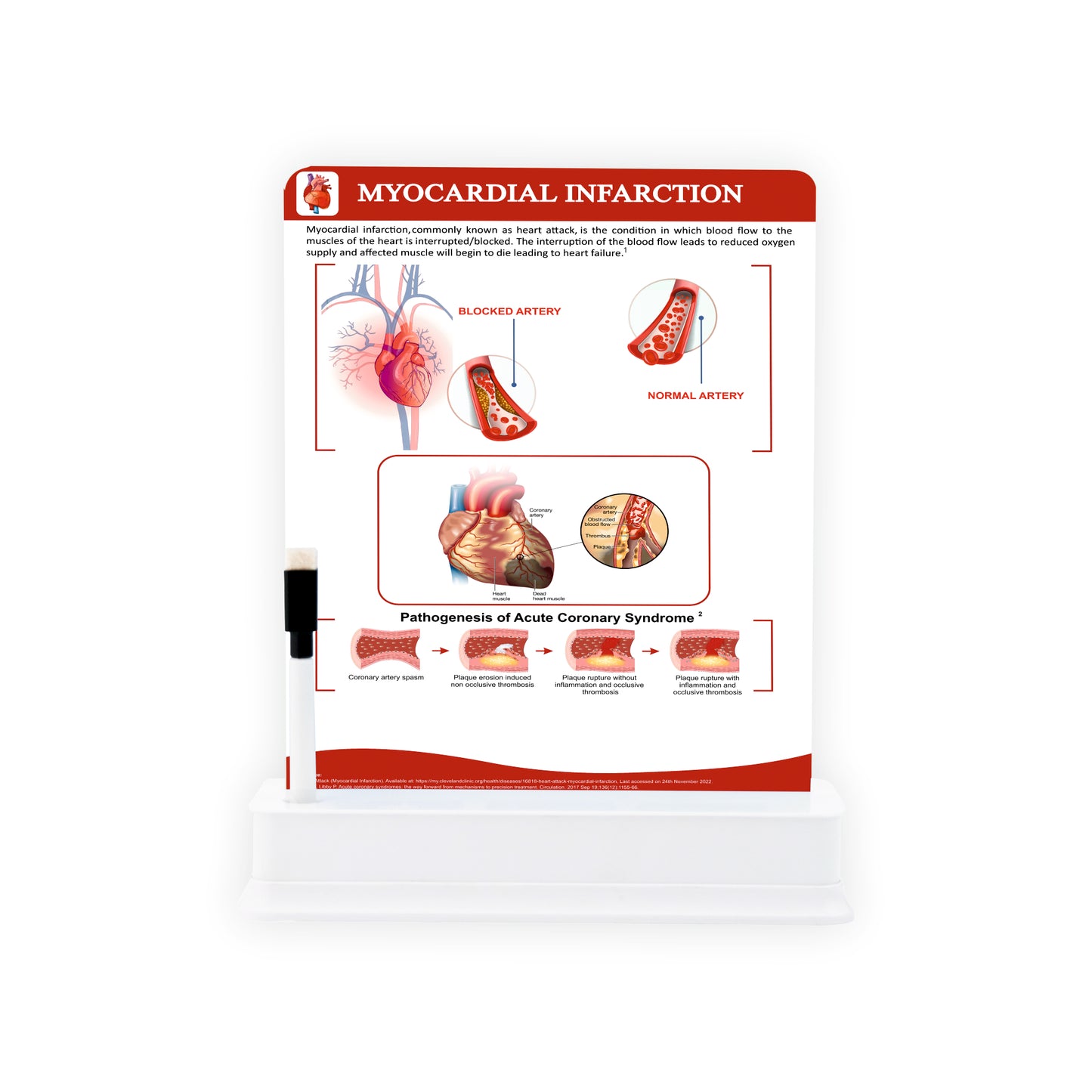 Myocardial Infarction: 1 Slide on stand