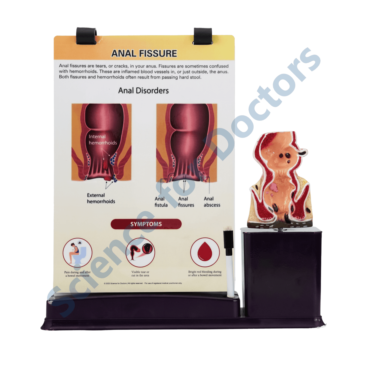 Anal Fissure: A4 Flip Wipe With Anatomical Model