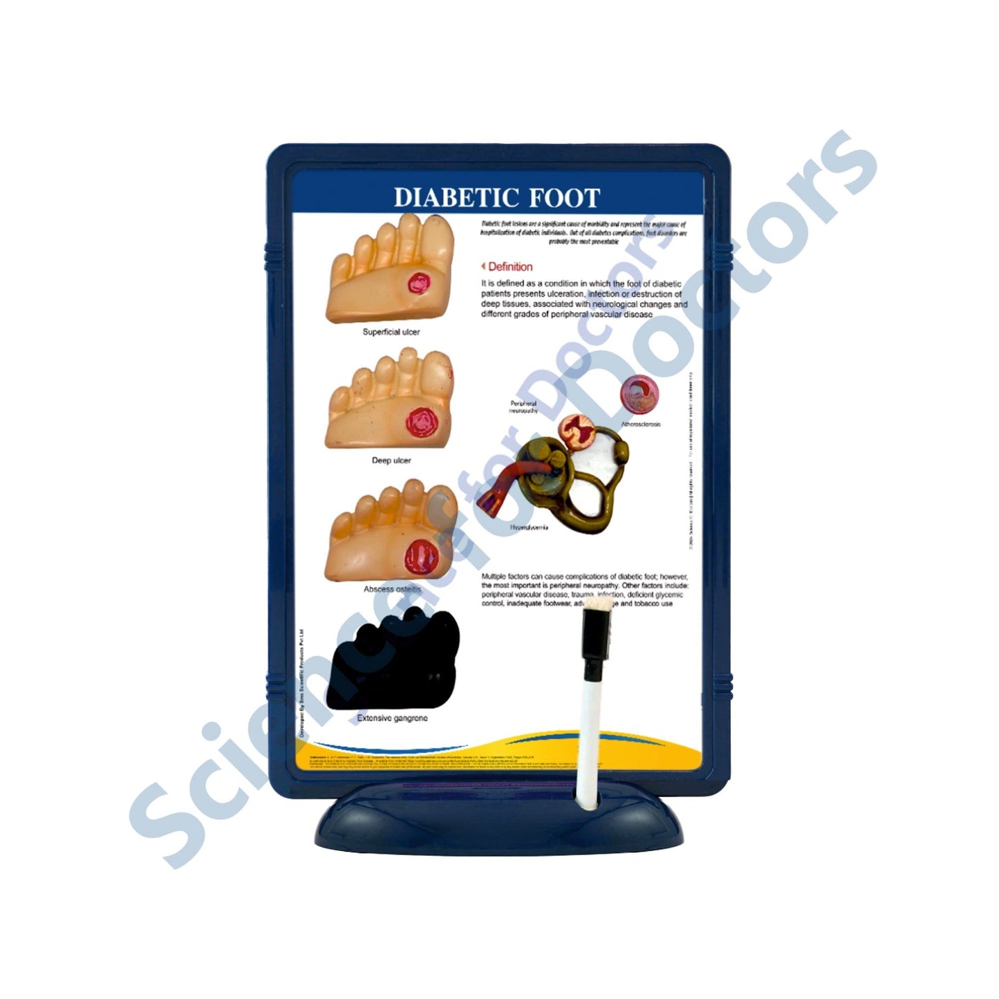 Diabetic Foot: The Frame Write & Wipe