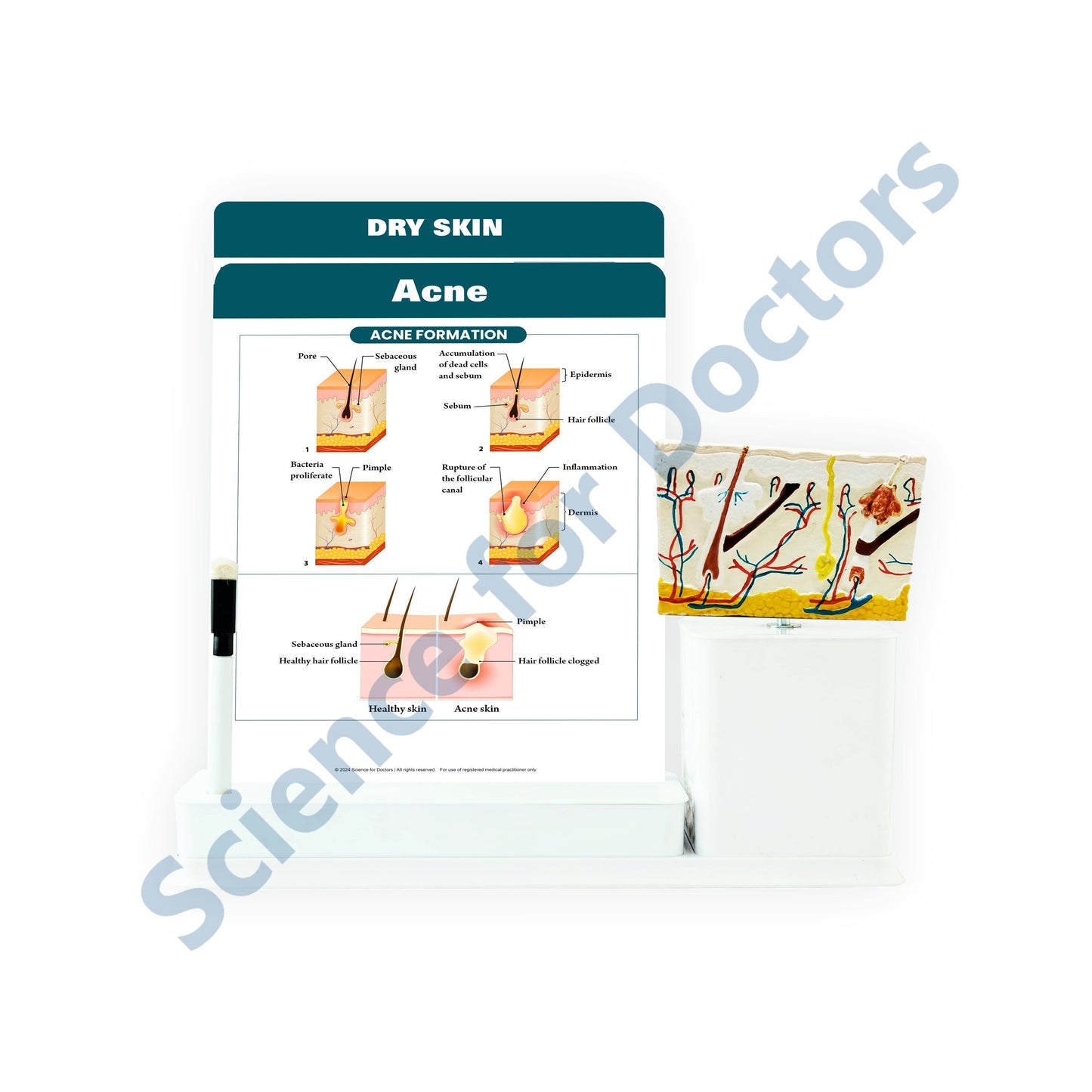 Acne: 2 Slides Write and Wipe with Anatomical Model On Stand