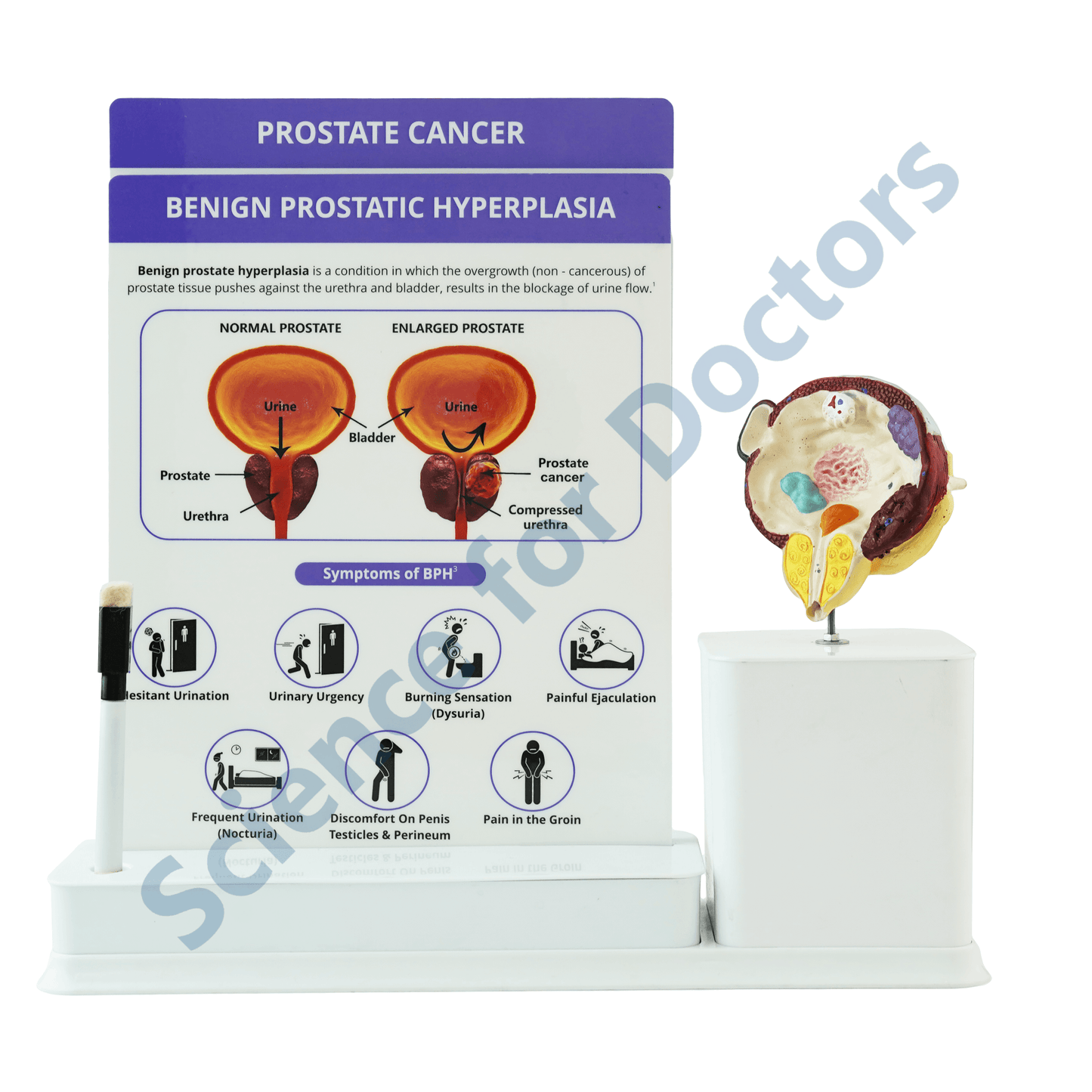 Prostate Cancer : 2 slide Write and Wipe with Anatomical Model