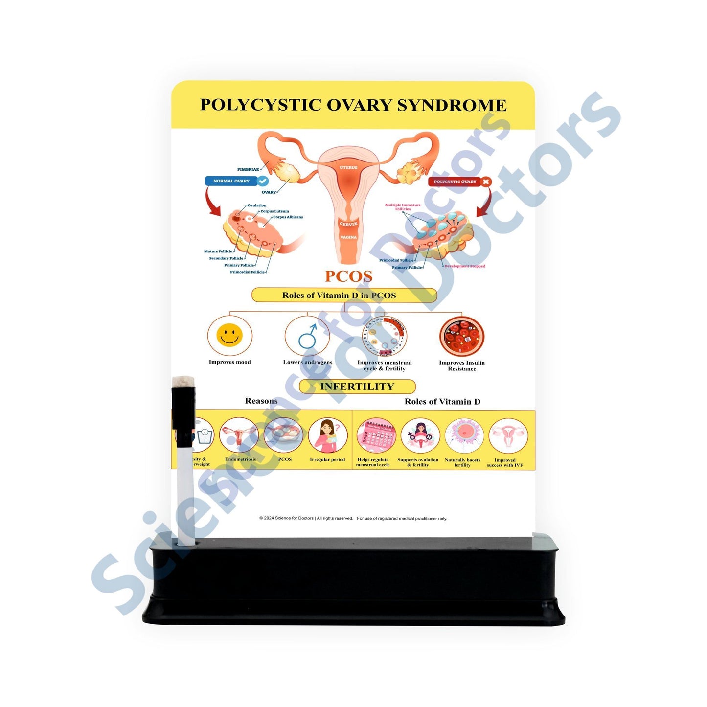 Polycystic Ovary Syndrome: 1 Slide on stand