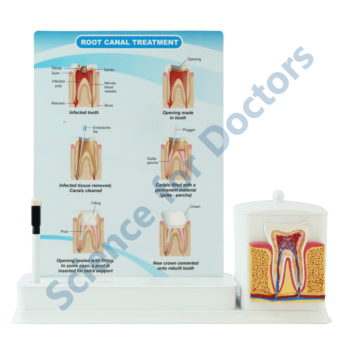 Root Canal Treatment : 1 Slide Write and wipe with anatomical model on stationery stand