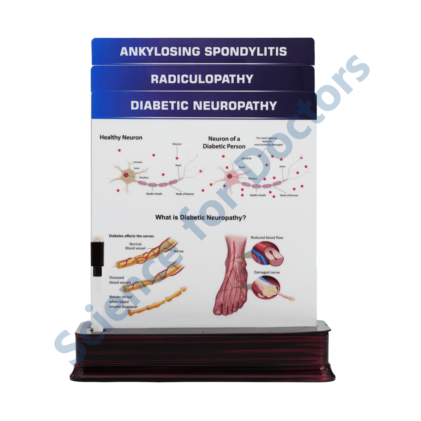 Diabetic Neuropathy: 3 slide on stand