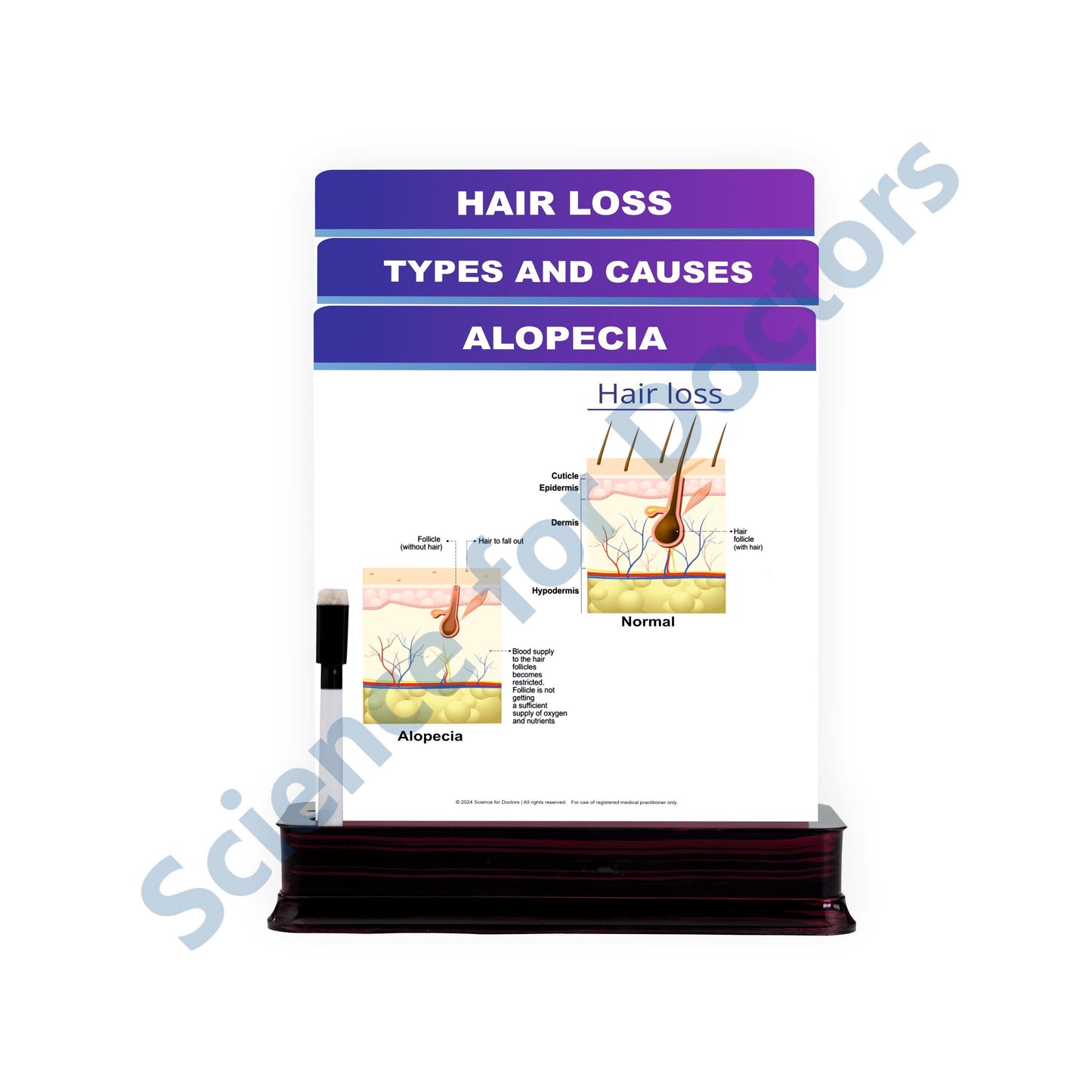 Alopecia: 3 Slides on stand