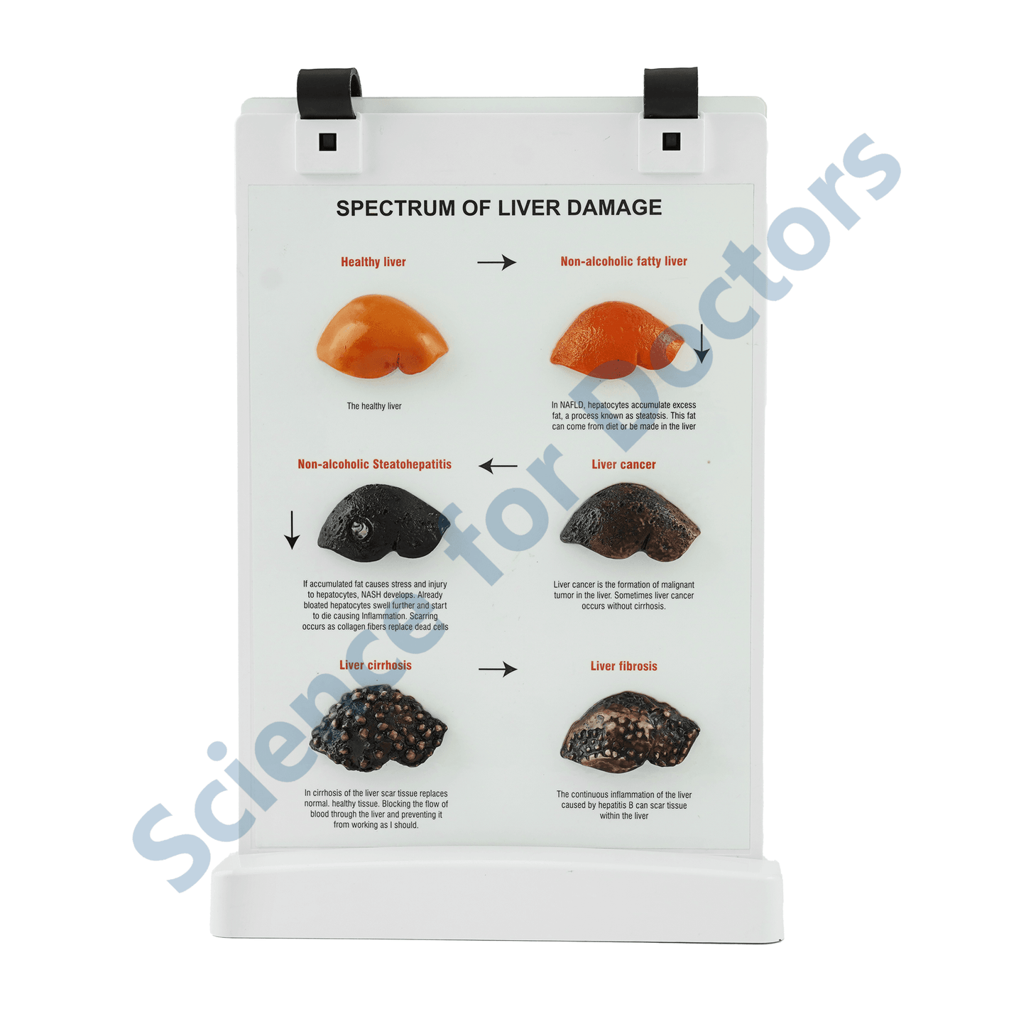 Fatty Liver Disease: A4 Flip Wipe with 3D Therapy Board