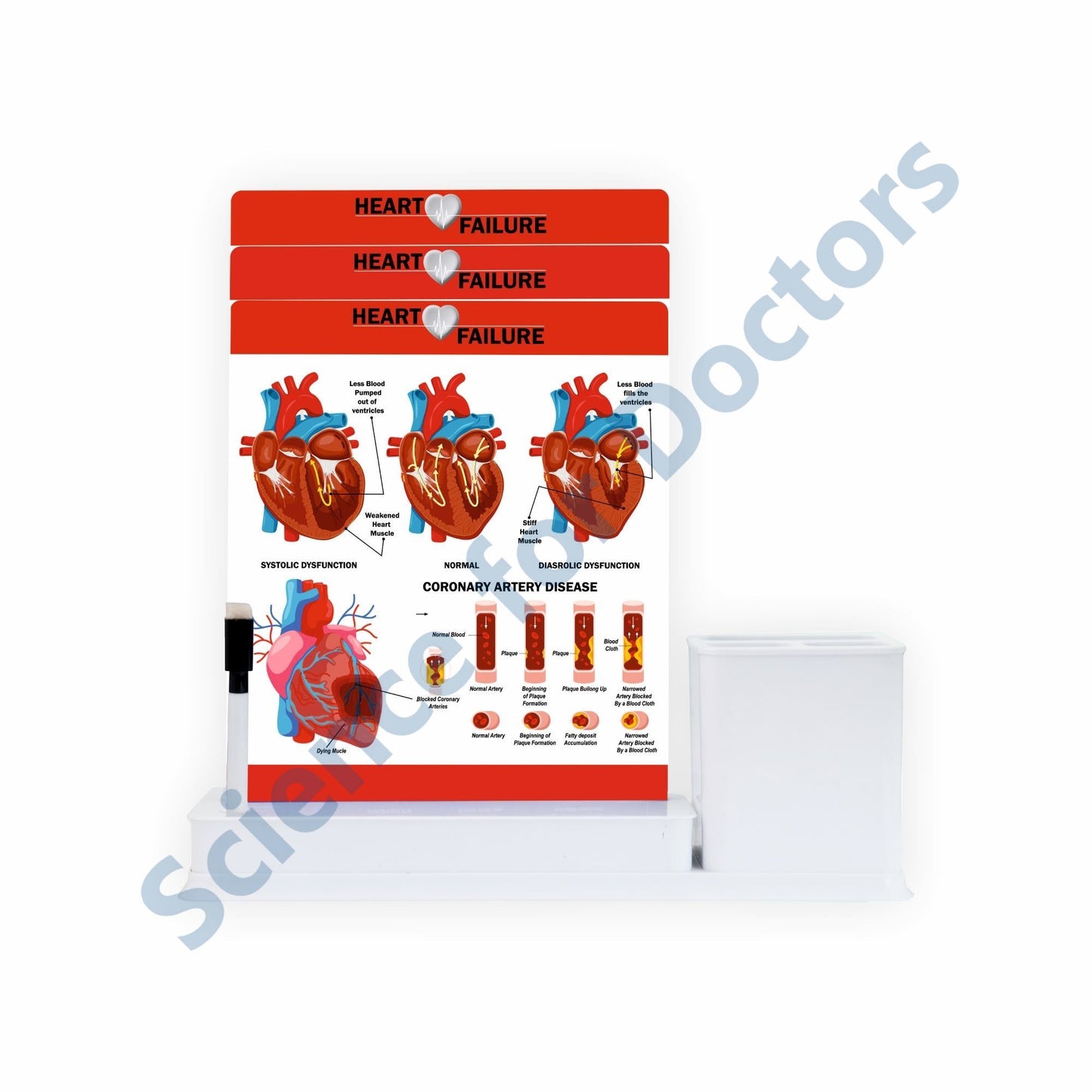 Heart Failure: 3 Slides Write & Wipe with Stationary Stand