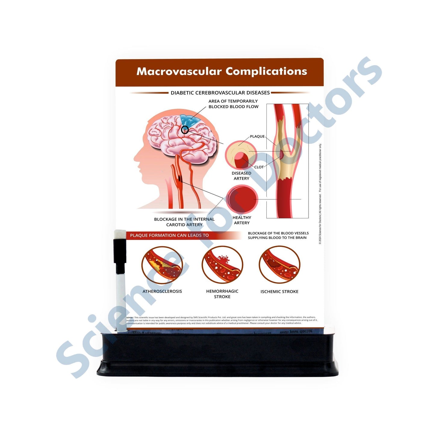 Macrovascular Complications: 1 Slide on stand