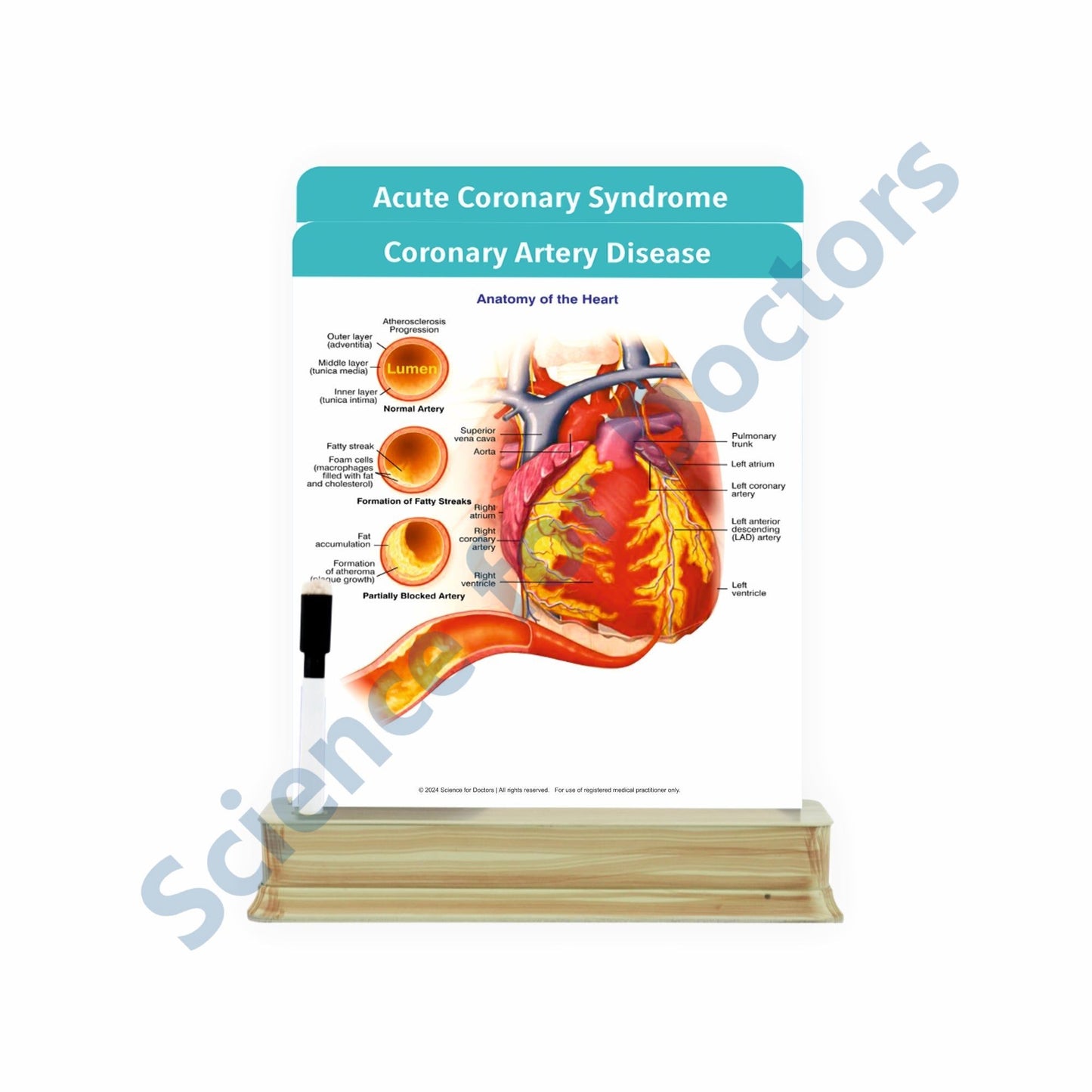 Coronary Artery Disease: 2 slide on stand