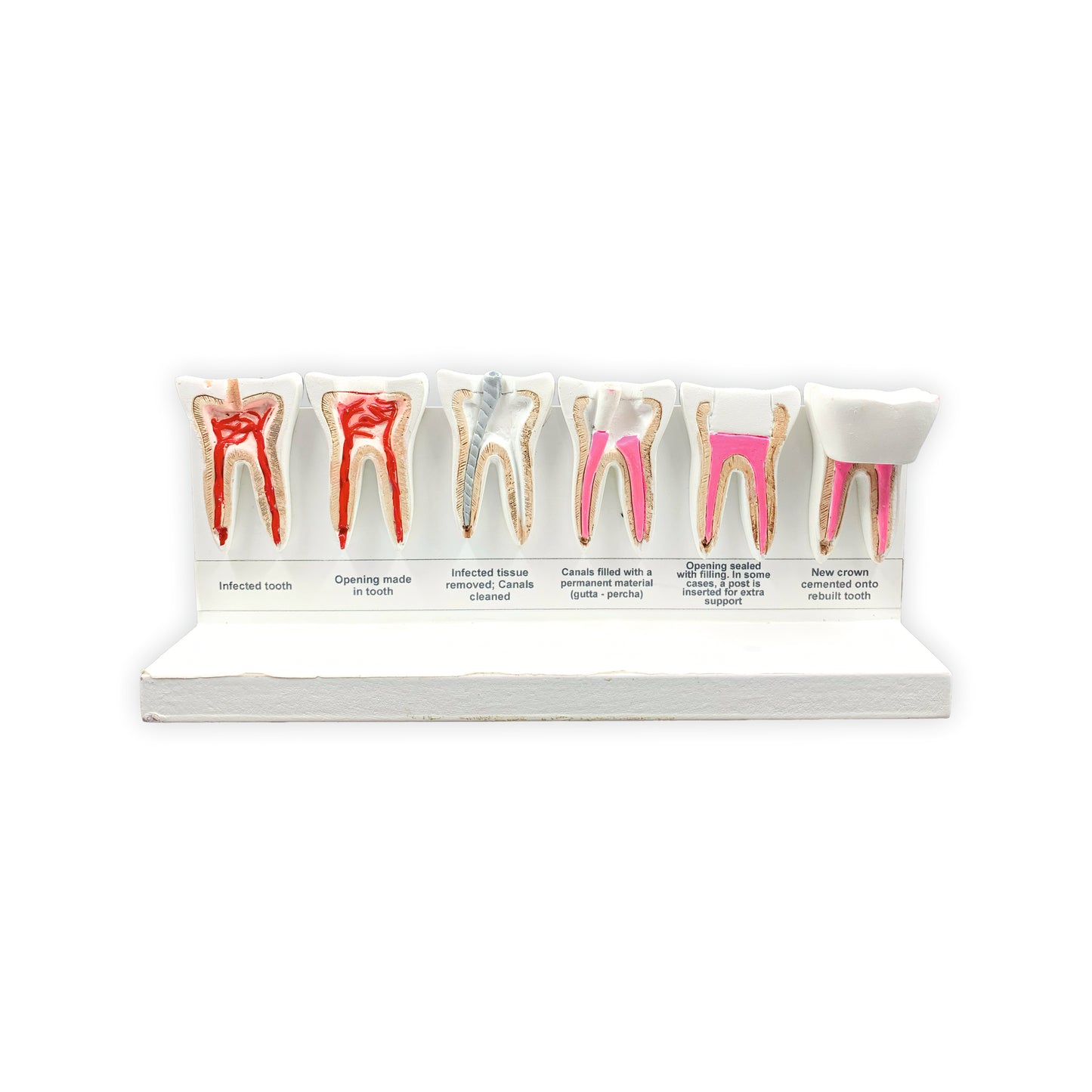 Stages of Root Canal: 3D Anatomical Models