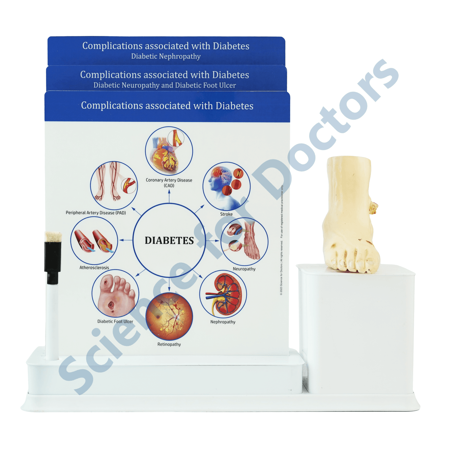 Diabetes Complication : 3 Slide Write and Wipe with Anatomical Model on Stand