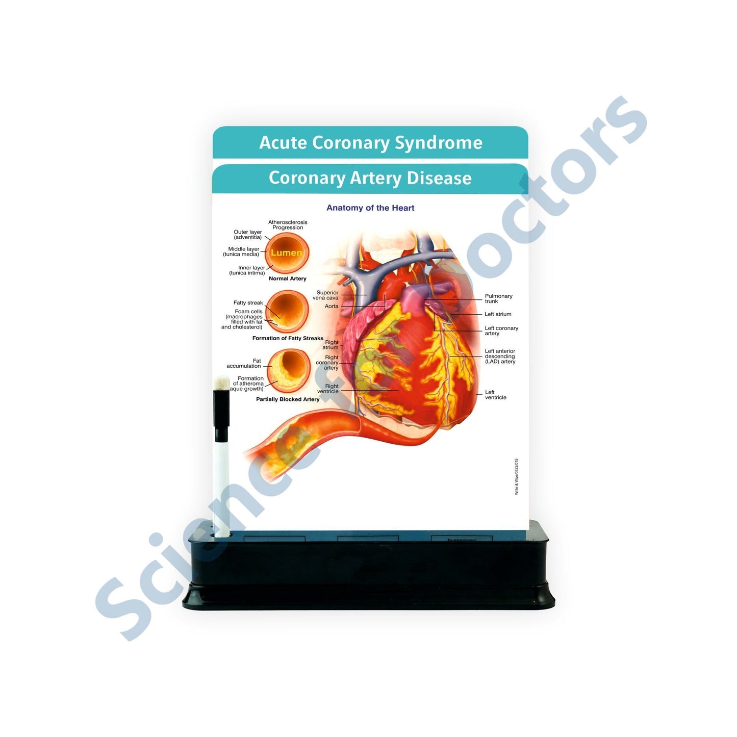 Coronary Artery Disease: 2 Slides with Stand