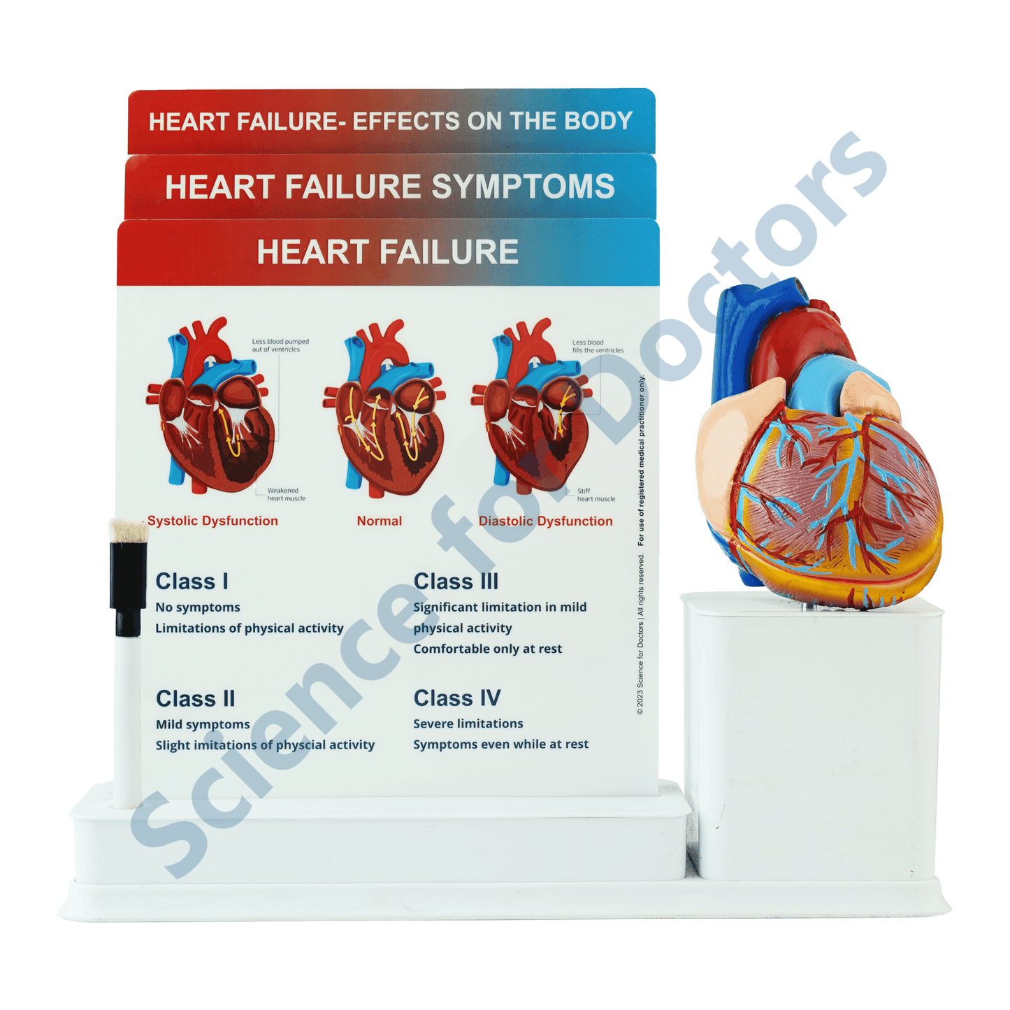 Heart Failure: 3 Slide Write and Wipe with Anatomical Model on Stand