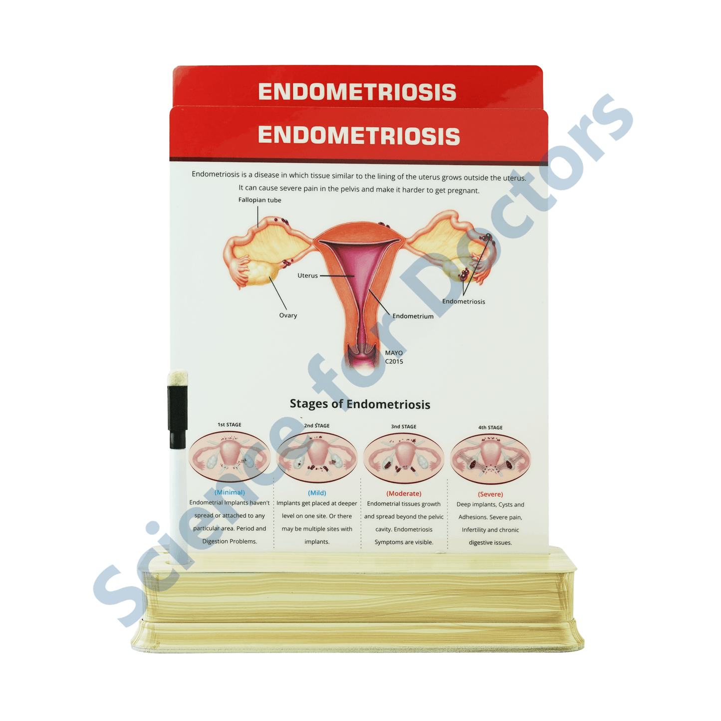 Endometriosis (1): 2 Slide on stand