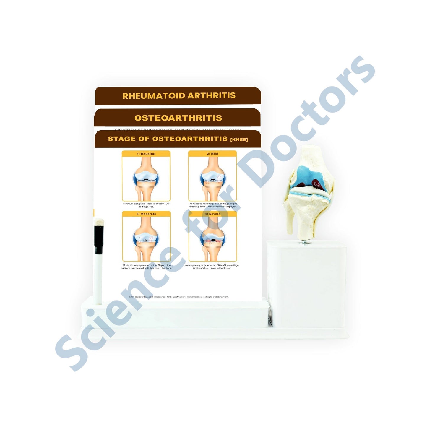 STAGE OF OSTEOARTHRITIS [KNEE]: 3 Slide Write and Wipe with Anatomical Model on Stand