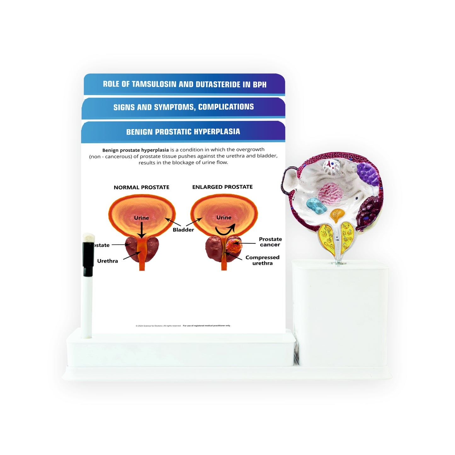 Benign Prostatic Hyperplasia_1 : 3 Slides Write & Wipe With Model On Stand