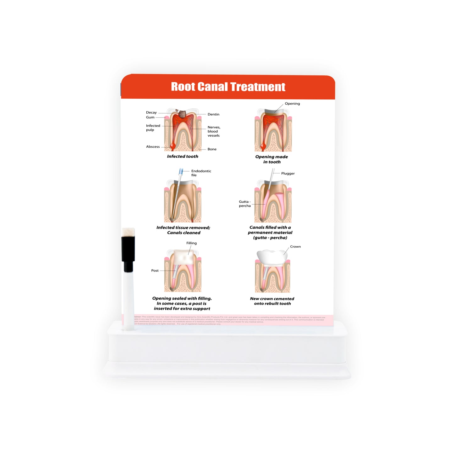 Root Canal Treatment: 1 Slide on stand