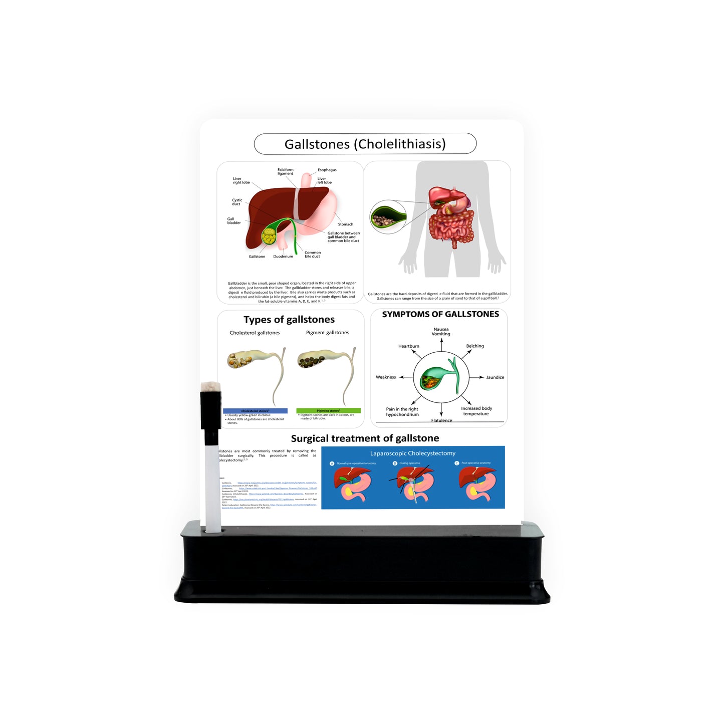 Gallstones (Cholelithiasis): 1 Slide with Stand