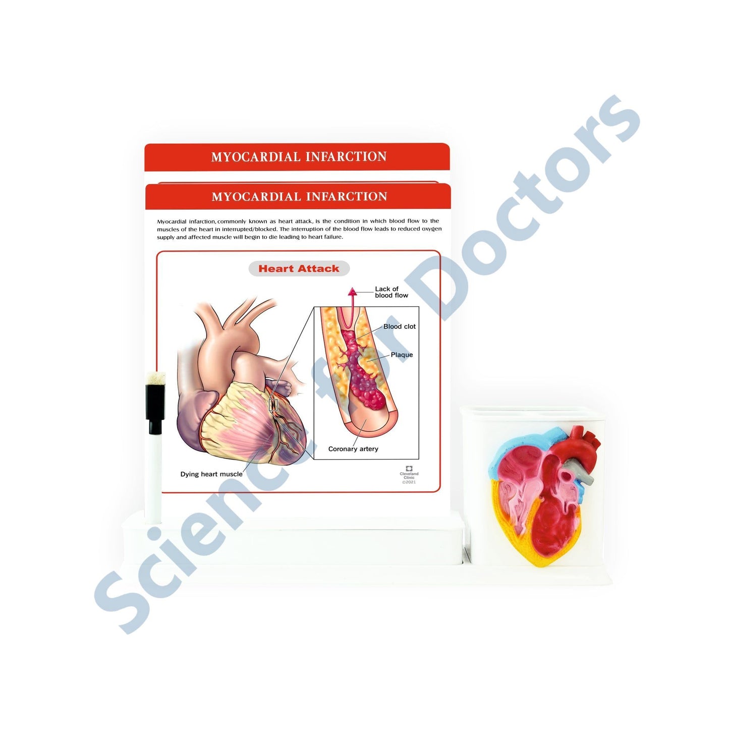 2 slides write & wipe with anatomical model on Stationary Stand - Myocardial Infarction_1