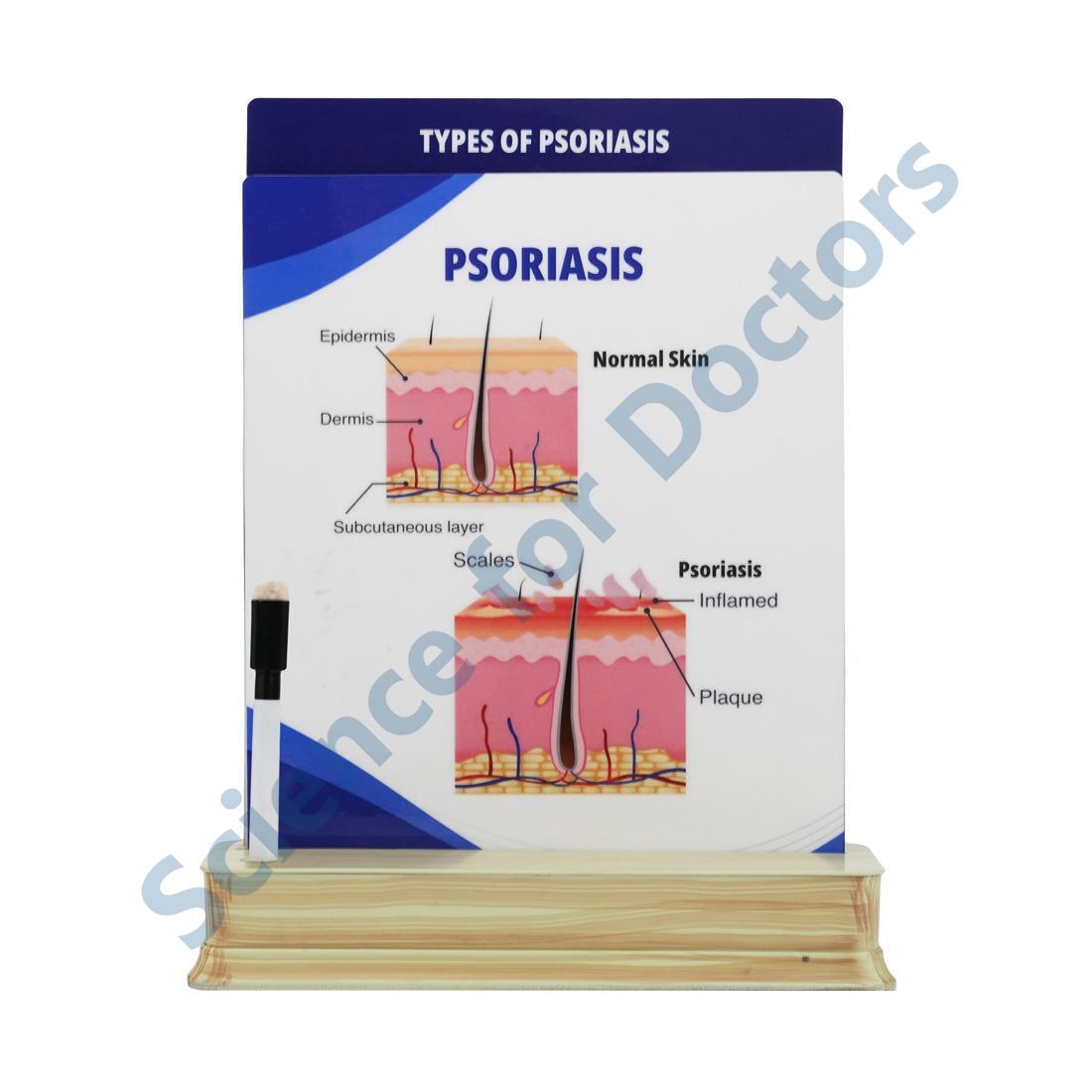 Psoriasis: 2 Slide on stand