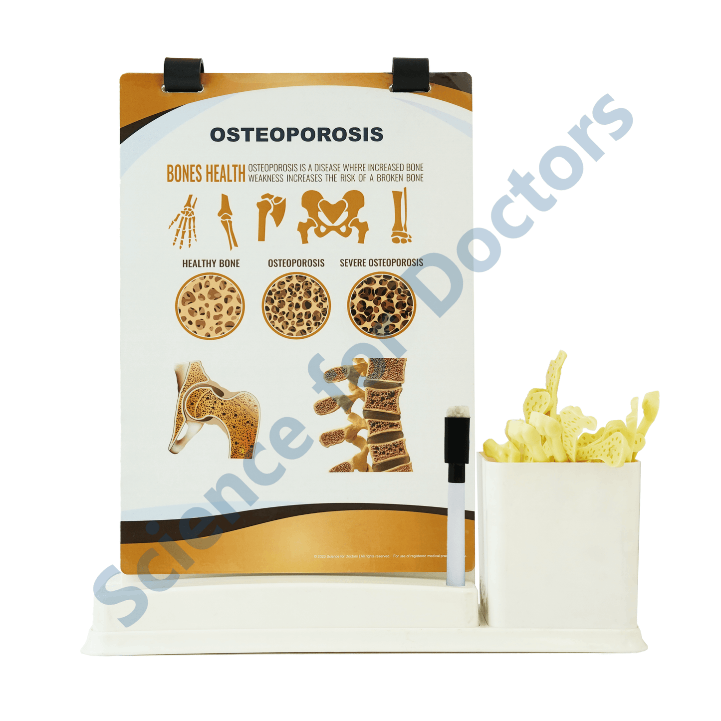 Osteoporosis: A4 Flip Wipe With Anatomical Model