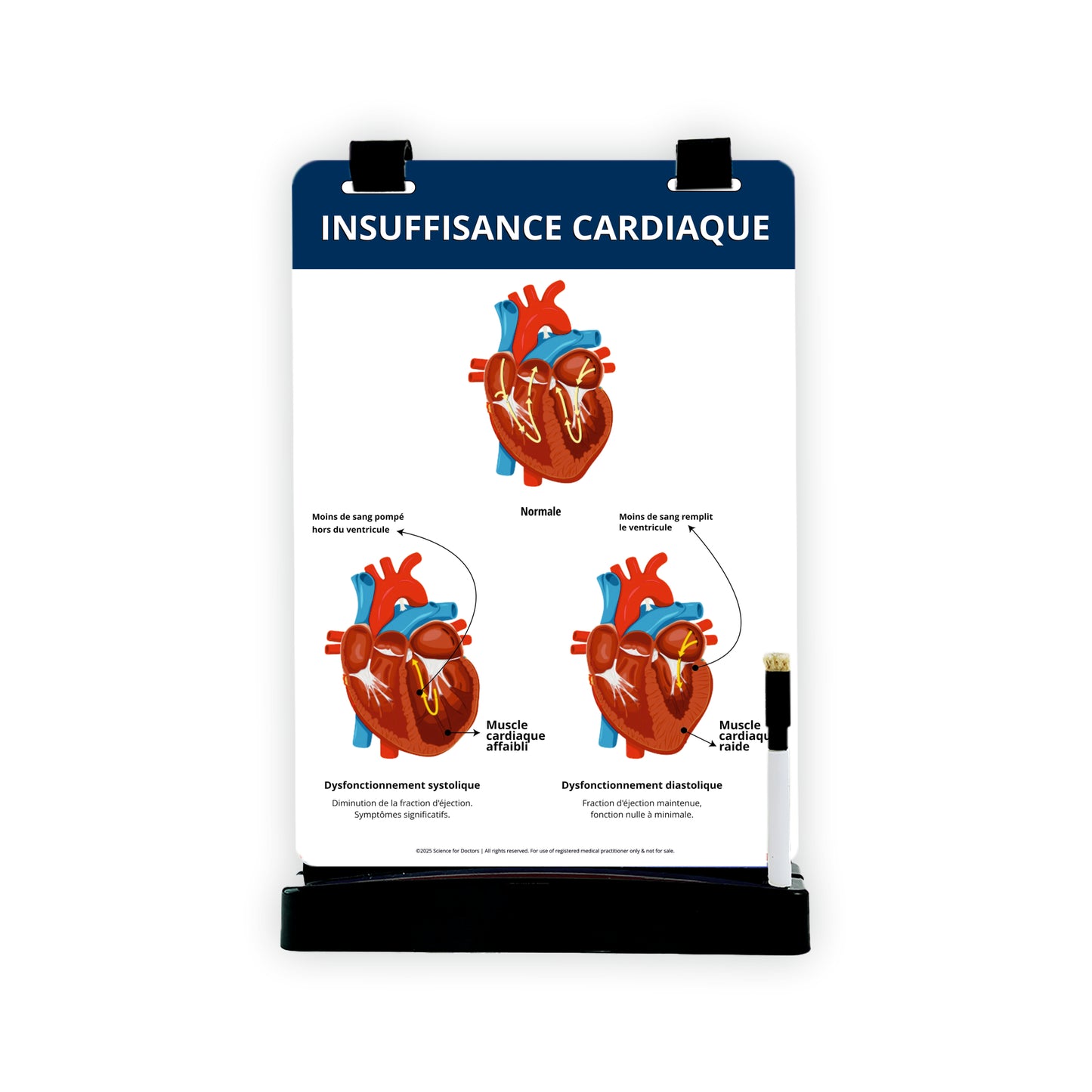 Insuffisance Cardiaque: A4 Flip Wipe