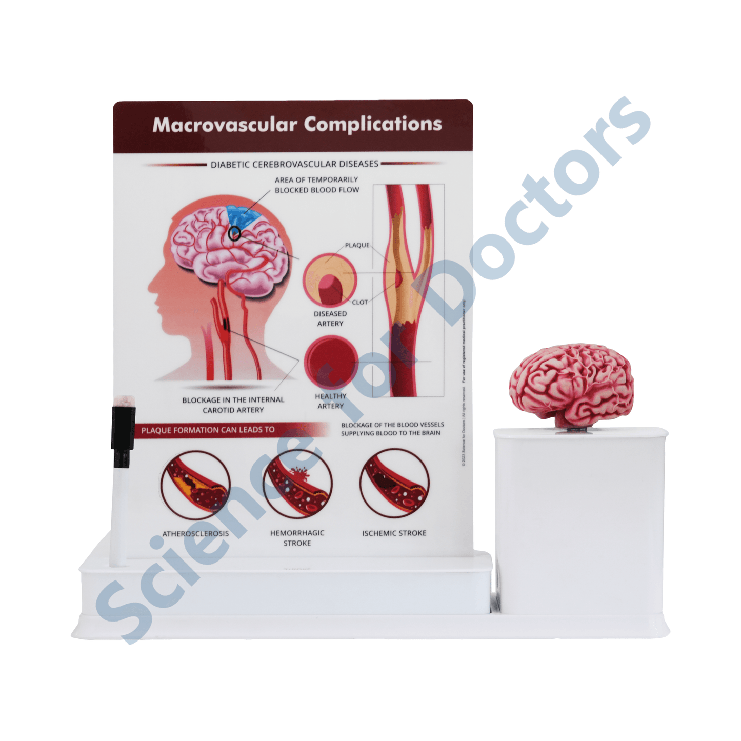 Macrovascular Complications Diabetic Cerebrovascular Diseases : 1 Slide write and wipe with anatomical model on stand