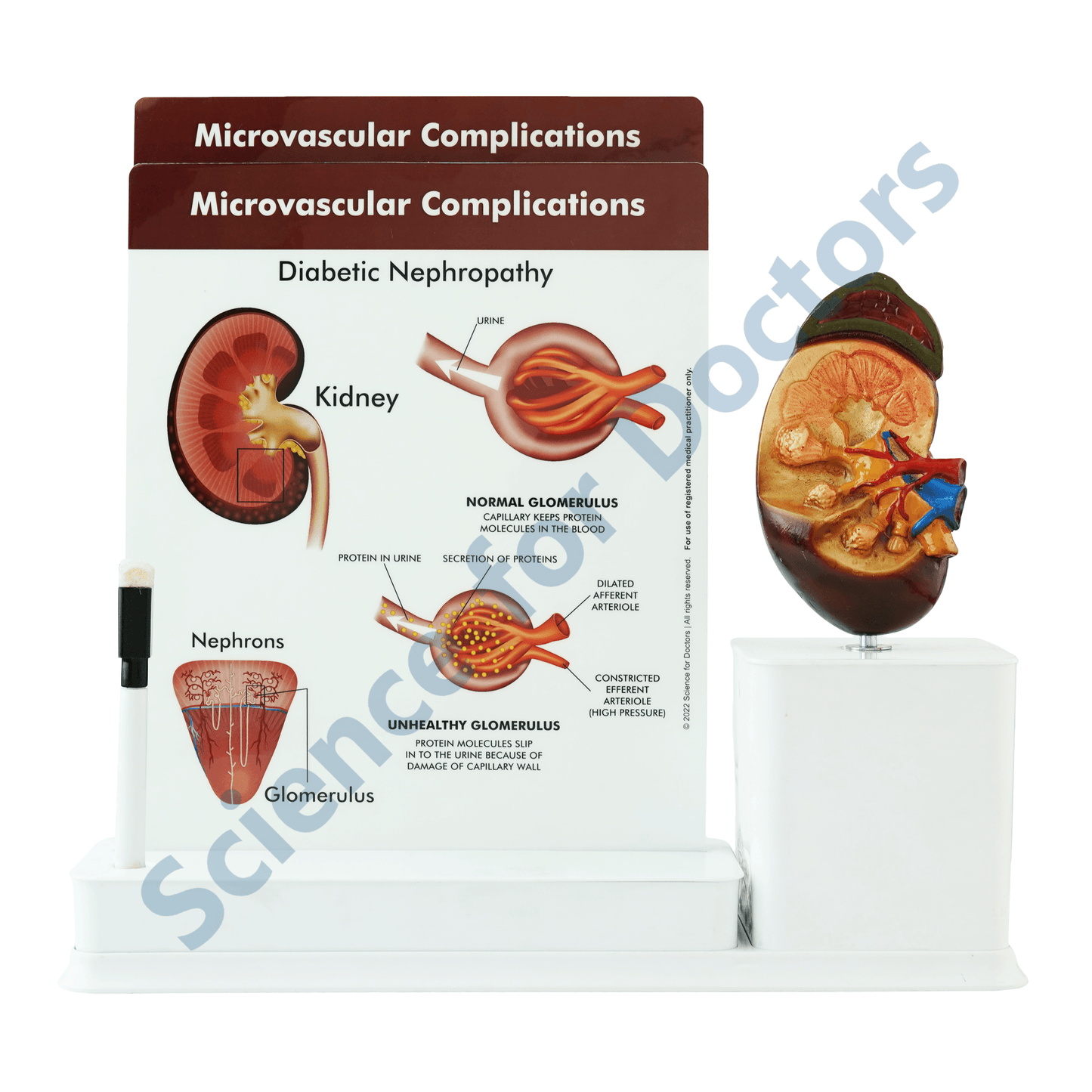 Microvascular Complications  : 2 slide Write and Wipe with Anatomical Model