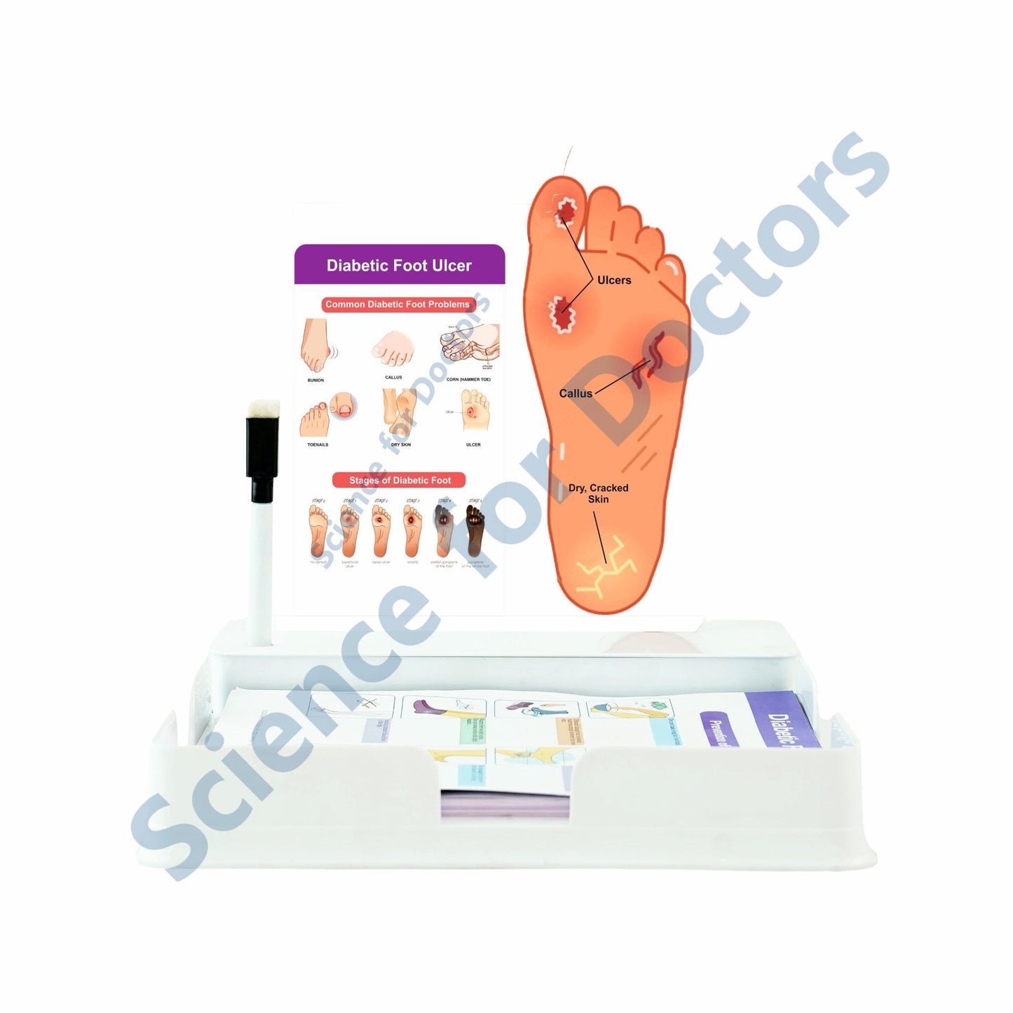 Diabetic Foot Ulcer: 1 Slide with Patient Leaflet Tray